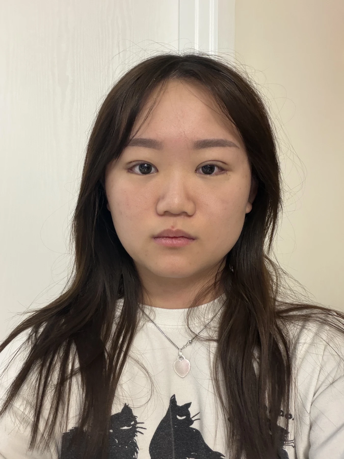 Eye-area surgery: three-month photo timeline · Case 083 at Answer Plastic Surgery. Front view — 1 week after surgery, eye-area surgery at Answer Plastic Surgery (case 083).