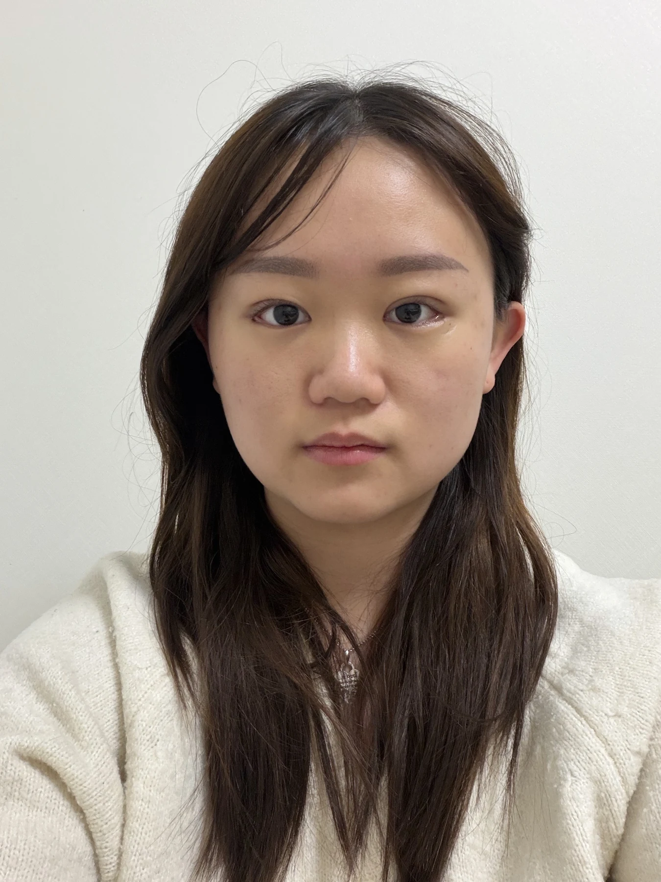 Eye-area surgery: three-month photo timeline · Case 083 at Answer Plastic Surgery. Front view — 2 weeks after surgery, eye-area surgery at Answer Plastic Surgery (case 083).