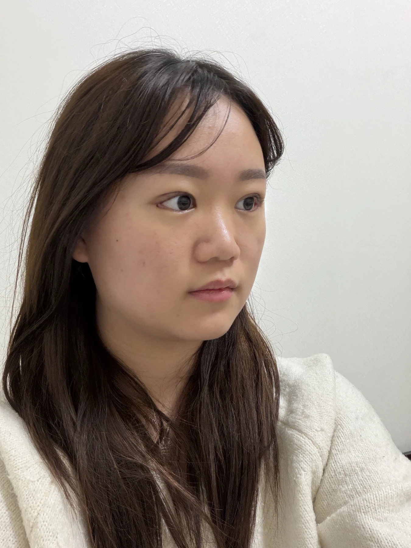 Eye-area surgery: three-month photo timeline · Case 083 at Answer Plastic Surgery. Oblique view — 2 weeks after surgery, eye-area surgery at Answer Plastic Surgery (case 083).