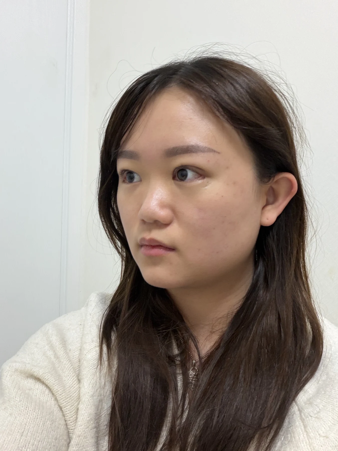 Eye-area surgery: three-month photo timeline · Case 083 at Answer Plastic Surgery. Opposite oblique view — 2 weeks after surgery, eye-area surgery at Answer Plastic Surgery (case 083).