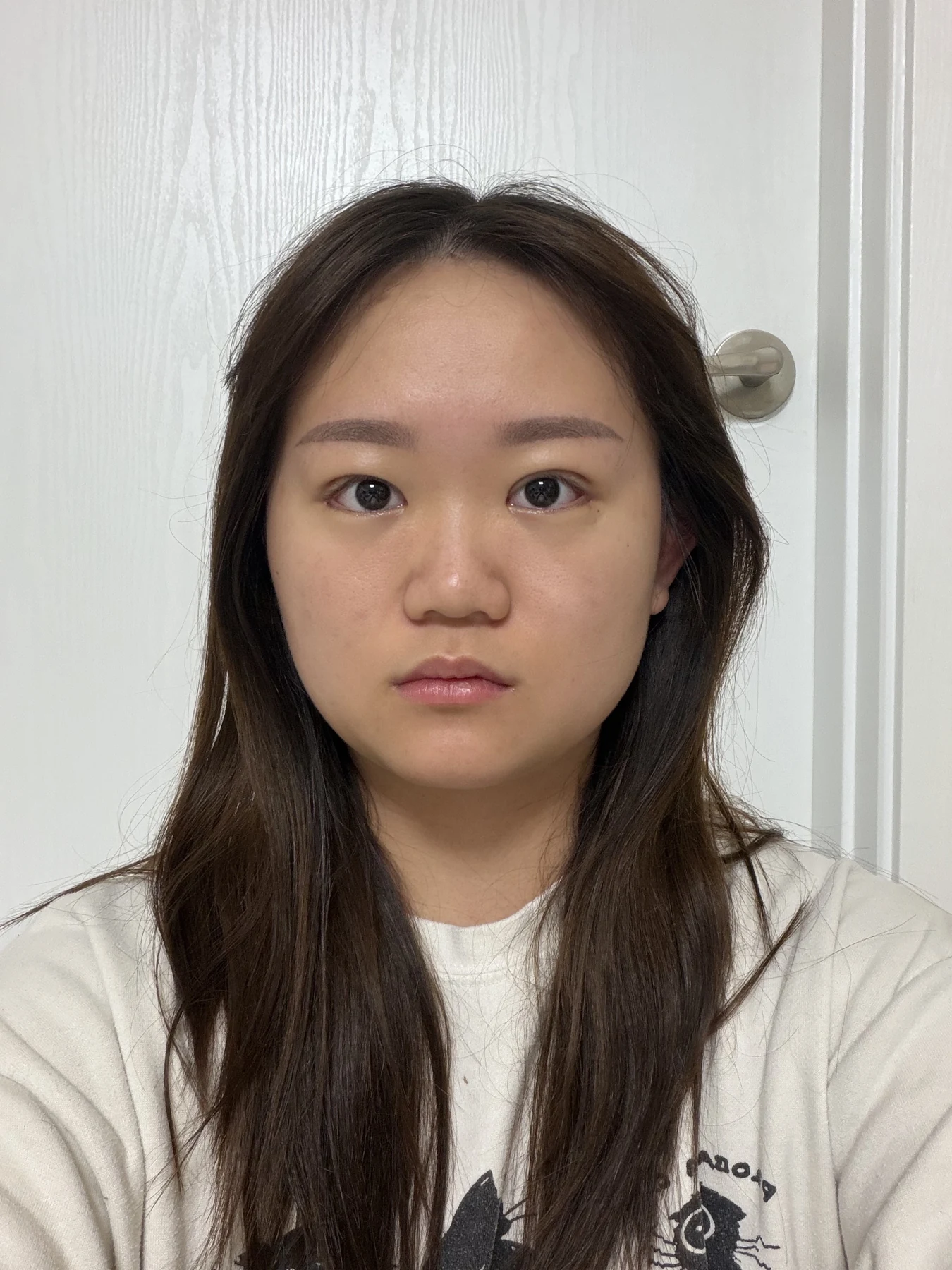 Eye-area surgery: three-month photo timeline · Case 083 at Answer Plastic Surgery. Front view — 3 weeks after surgery, eye-area surgery at Answer Plastic Surgery (case 083).