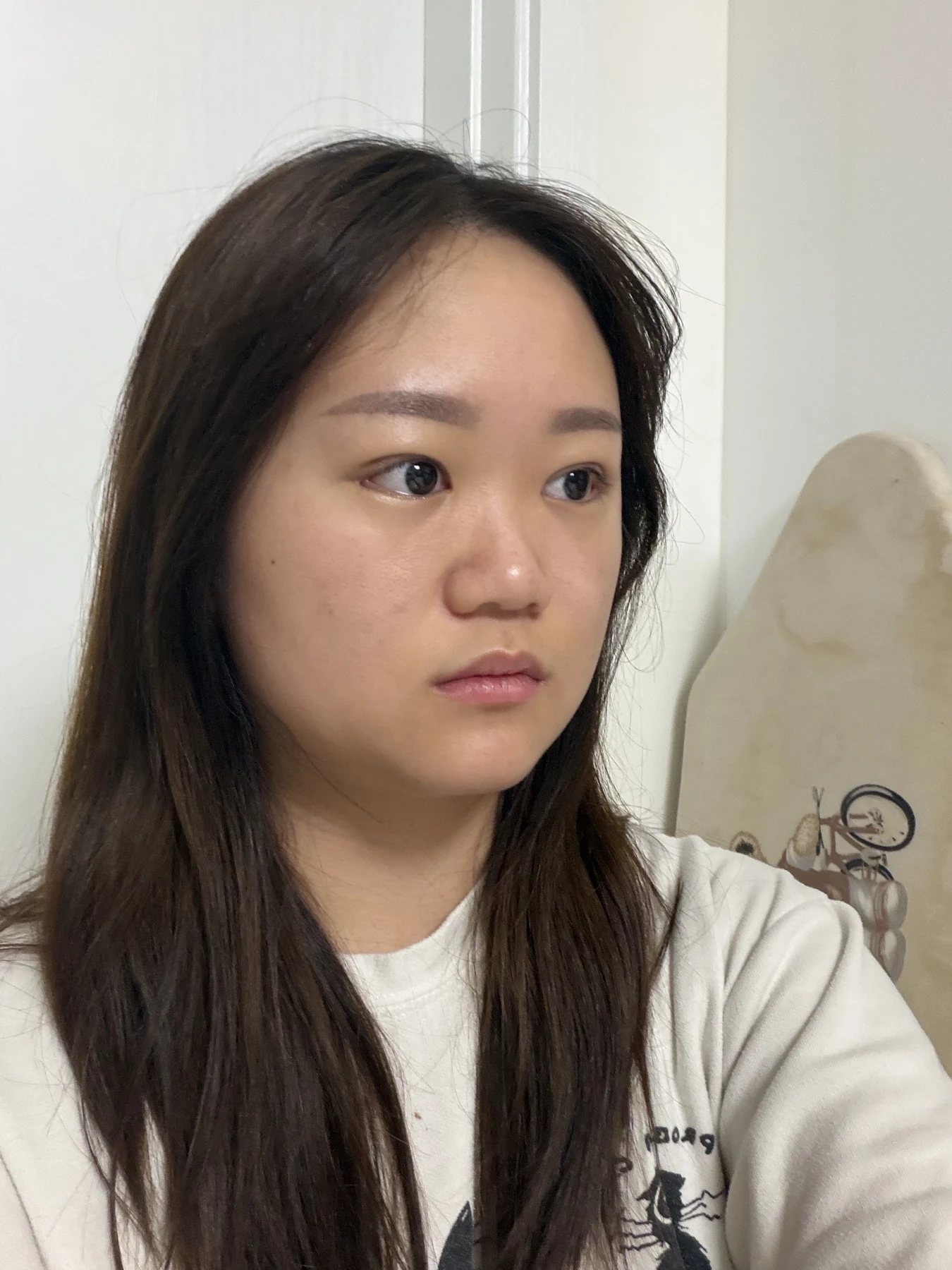 Eye-area surgery: three-month photo timeline · Case 083 at Answer Plastic Surgery. Oblique view — 3 weeks after surgery, eye-area surgery at Answer Plastic Surgery (case 083).