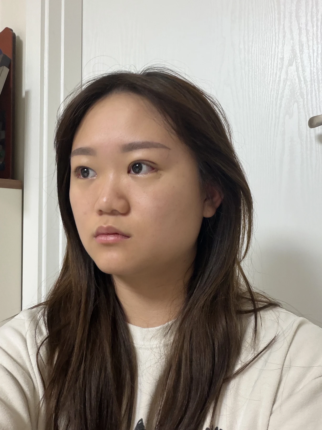Eye-area surgery: three-month photo timeline · Case 083 at Answer Plastic Surgery. Opposite oblique view — 3 weeks after surgery, eye-area surgery at Answer Plastic Surgery (case 083).