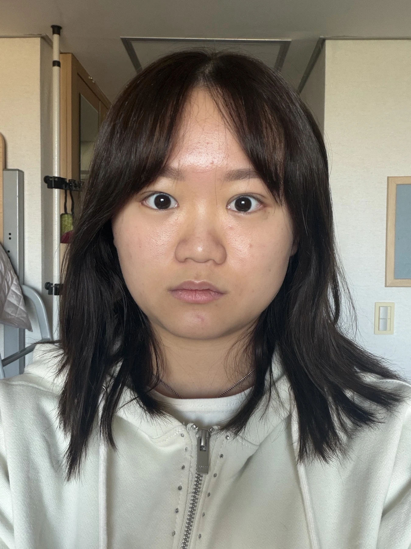 Eye-area surgery: three-month photo timeline · Case 083 at Answer Plastic Surgery. Front view — 1 month after surgery, eye-area surgery at Answer Plastic Surgery (case 083).