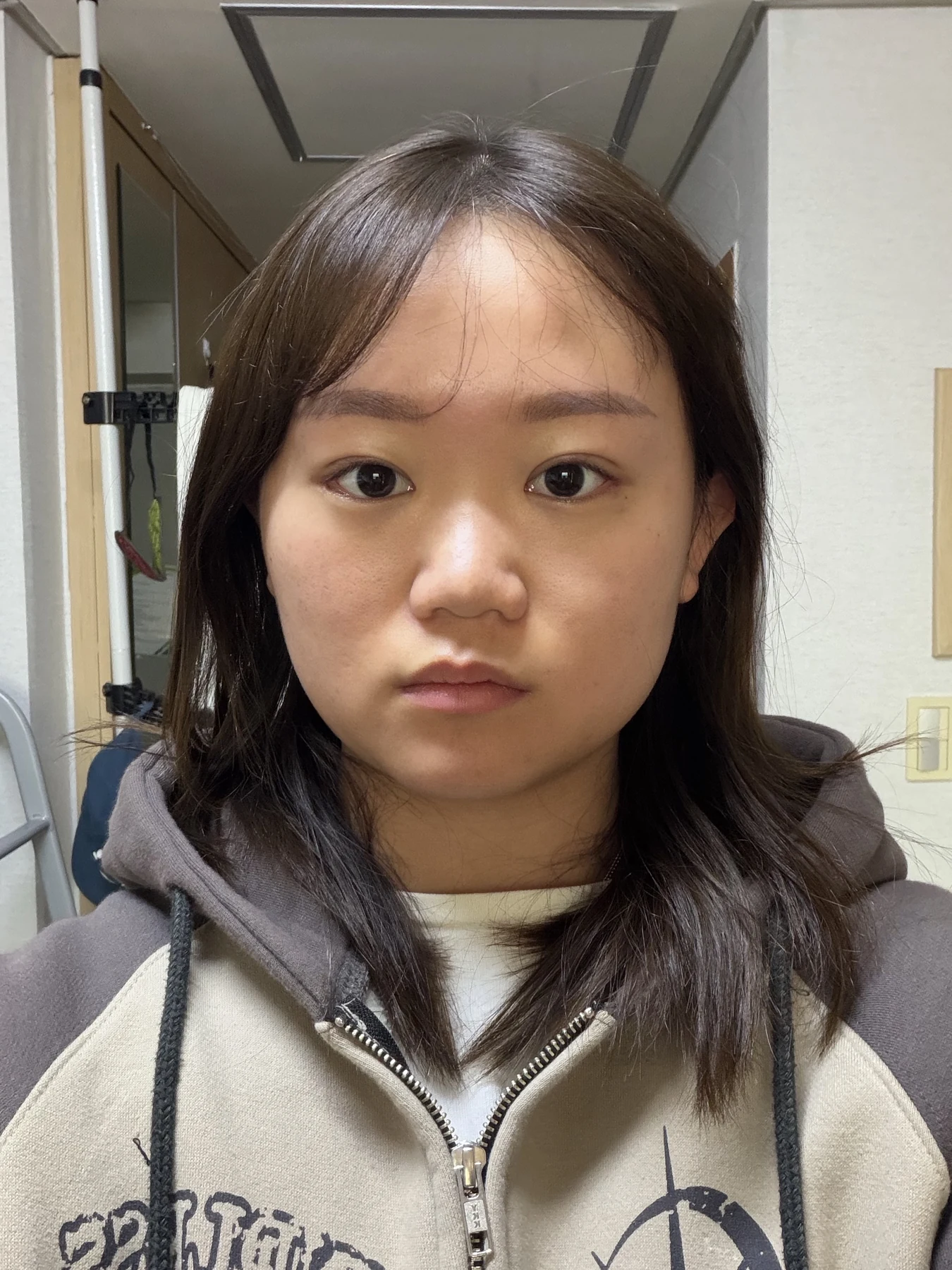 Eye-area surgery: three-month photo timeline · Case 083 at Answer Plastic Surgery. Front view — 2 months after surgery, eye-area surgery at Answer Plastic Surgery (case 083).