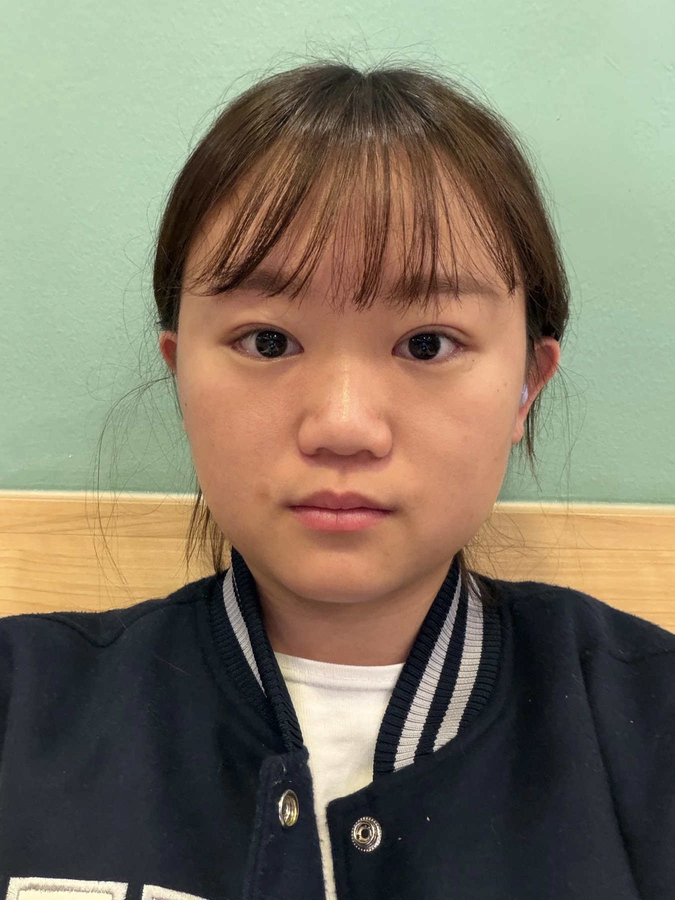 Eye-area surgery: three-month photo timeline · Case 083 at Answer Plastic Surgery. Front view — 3 months after surgery, eye-area surgery at Answer Plastic Surgery (case 083).