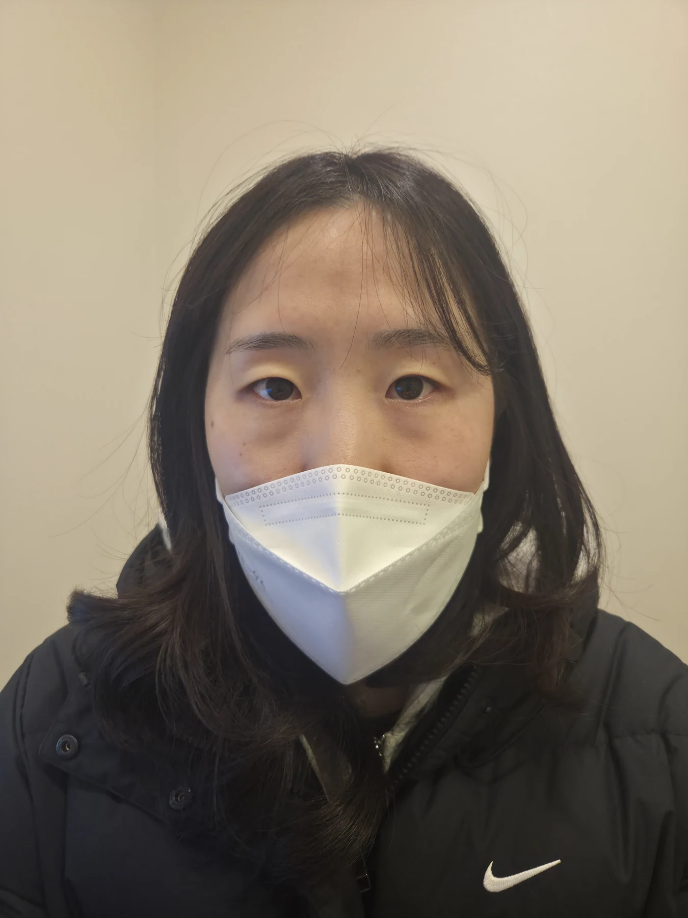 Eye-area surgery for a drooping-eyelid concern: six-month photographs · Case 084 at Answer Plastic Surgery. Front view — before, eye-area surgery for a drooping-eyelid concern at Answer Plastic Surgery (case 084).