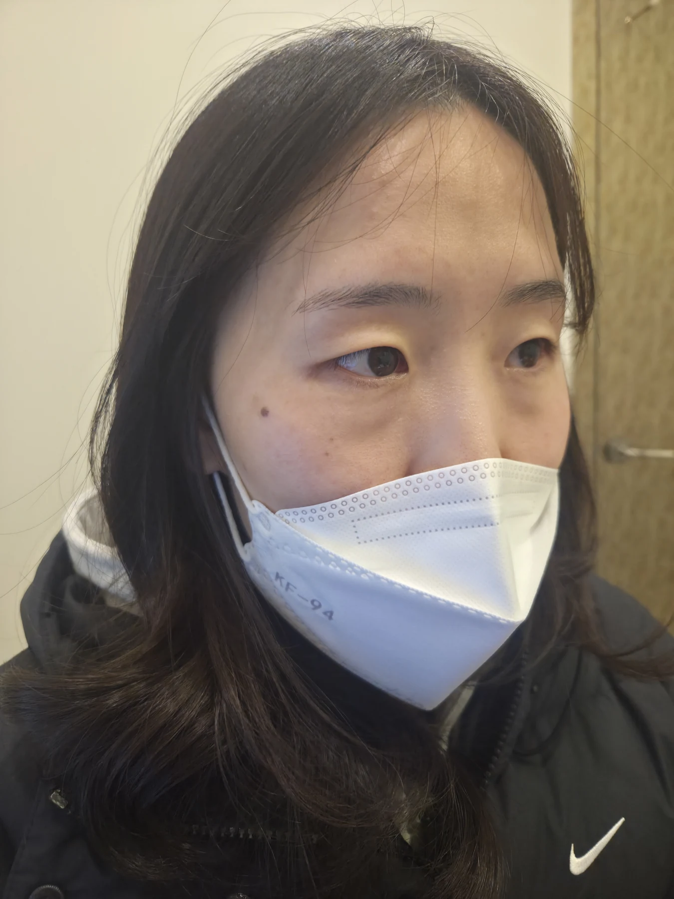 Eye-area surgery for a drooping-eyelid concern: six-month photographs · Case 084 at Answer Plastic Surgery. Oblique view — before, eye-area surgery for a drooping-eyelid concern at Answer Plastic Surgery (case 084).