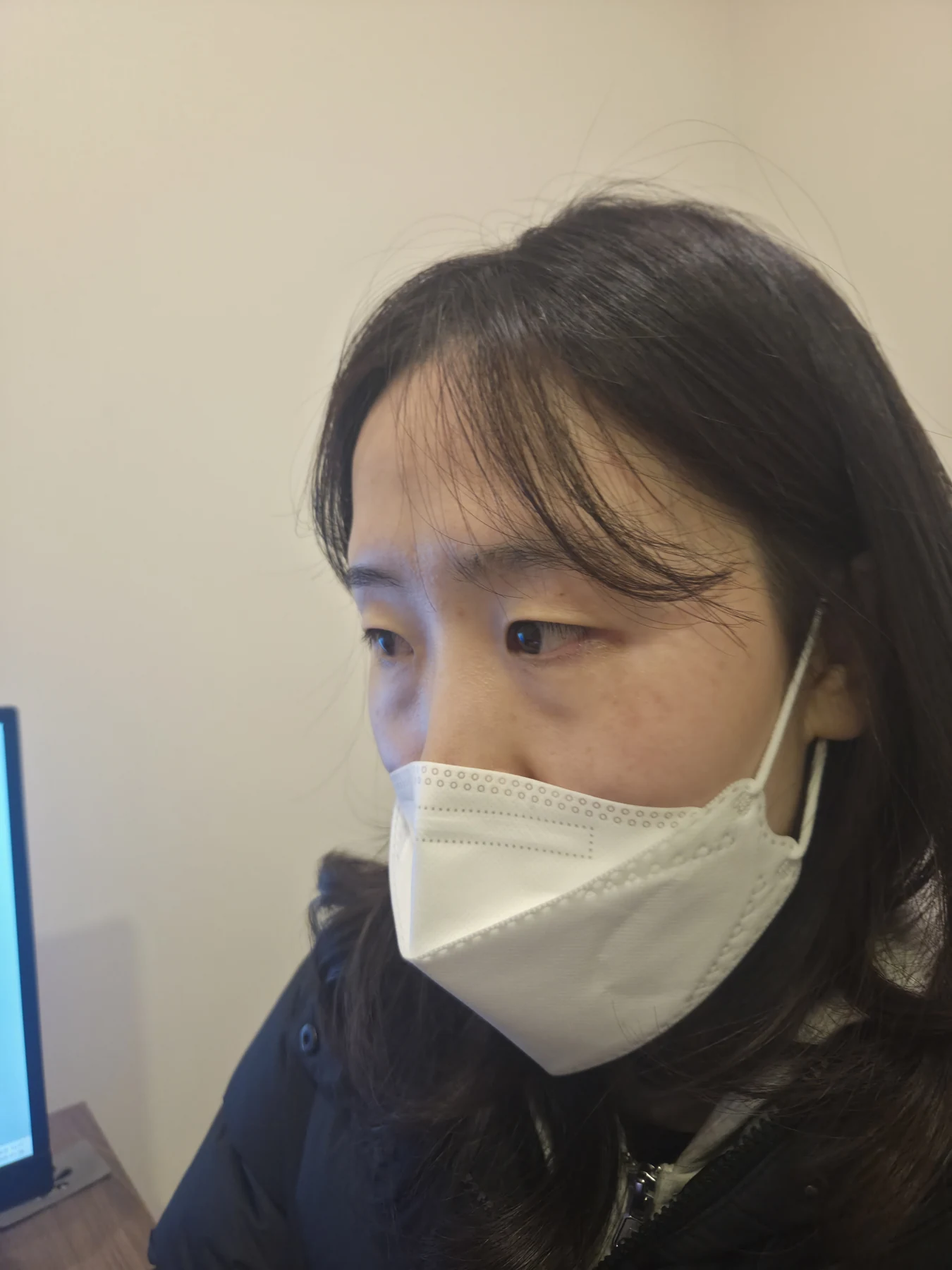 Eye-area surgery for a drooping-eyelid concern: six-month photographs · Case 084 at Answer Plastic Surgery. Opposite oblique view — before, eye-area surgery for a drooping-eyelid concern at Answer Plastic Surgery (case 084).