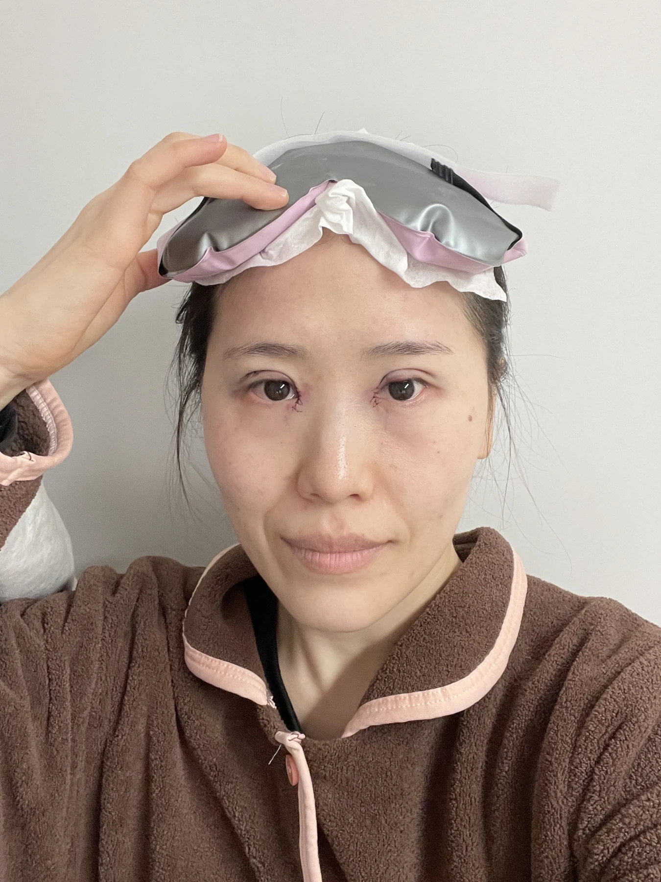 Eye-area surgery for a drooping-eyelid concern: six-month photographs · Case 084 at Answer Plastic Surgery. Front view — surgery day, eye-area surgery for a drooping-eyelid concern at Answer Plastic Surgery (case 084).