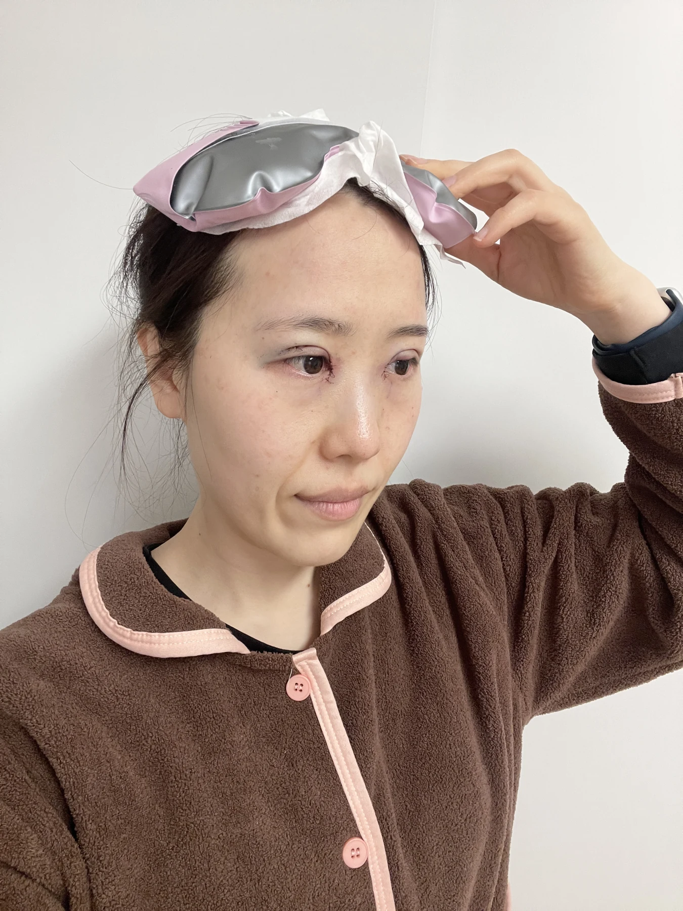 Eye-area surgery for a drooping-eyelid concern: six-month photographs · Case 084 at Answer Plastic Surgery. Oblique view — surgery day, eye-area surgery for a drooping-eyelid concern at Answer Plastic Surgery (case 084).
