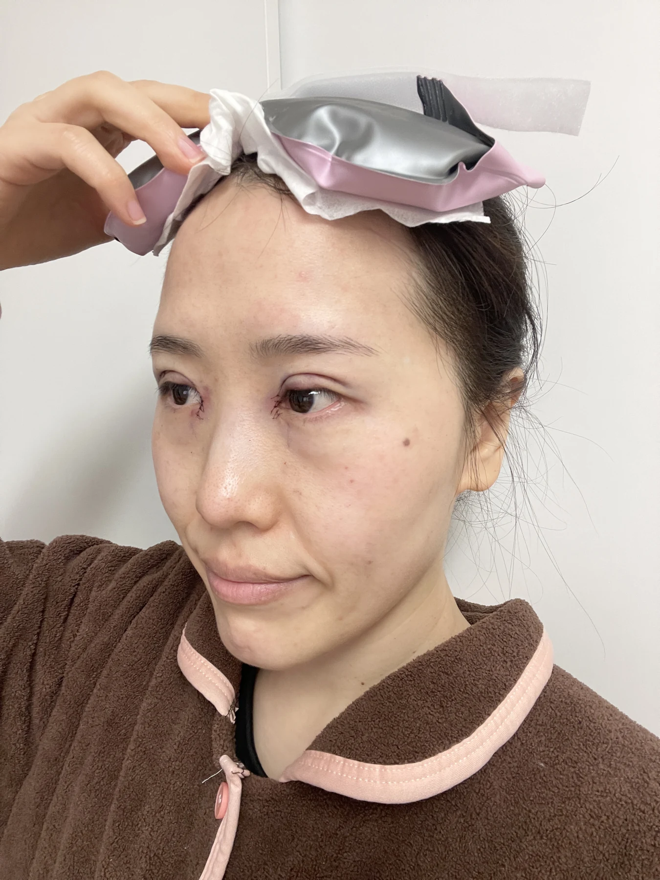 Eye-area surgery for a drooping-eyelid concern: six-month photographs · Case 084 at Answer Plastic Surgery. Opposite oblique view — surgery day, eye-area surgery for a drooping-eyelid concern at Answer Plastic Surgery (case 084).