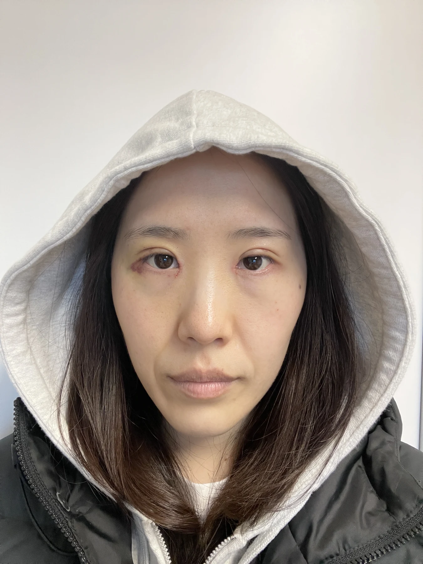 Eye-area surgery for a drooping-eyelid concern: six-month photographs · Case 084 at Answer Plastic Surgery. Front view — 1 week after surgery, eye-area surgery for a drooping-eyelid concern at Answer Plastic Surgery (case 084).
