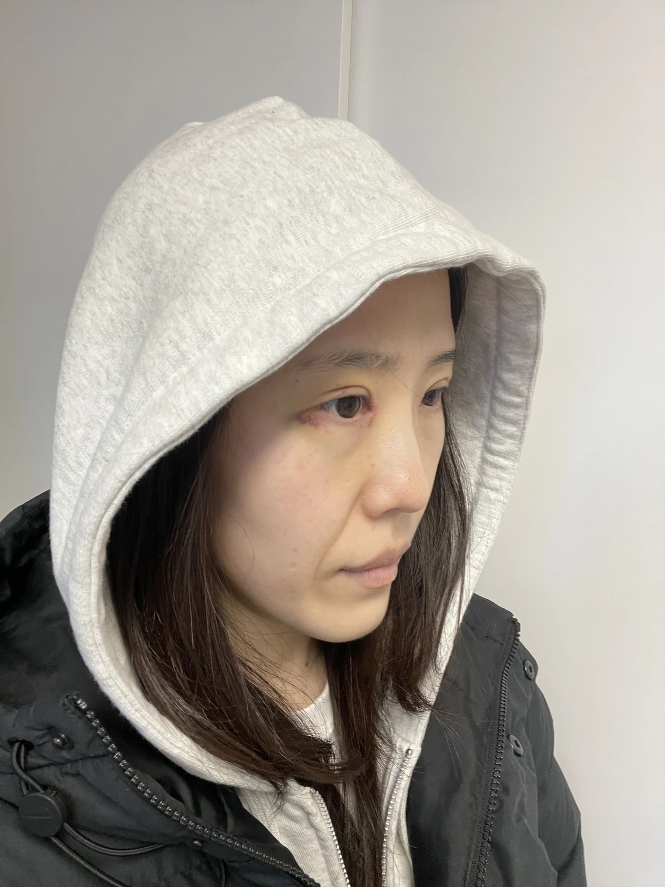 Eye-area surgery for a drooping-eyelid concern: six-month photographs · Case 084 at Answer Plastic Surgery. Oblique view — 1 week after surgery, eye-area surgery for a drooping-eyelid concern at Answer Plastic Surgery (case 084).