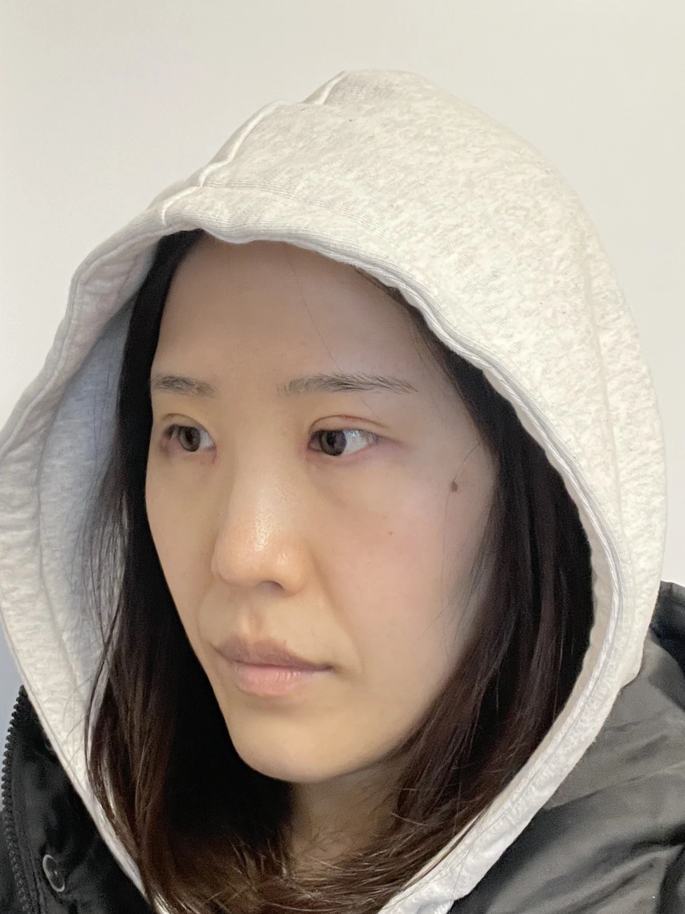 Eye-area surgery for a drooping-eyelid concern: six-month photographs · Case 084 at Answer Plastic Surgery. Opposite oblique view — 1 week after surgery, eye-area surgery for a drooping-eyelid concern at Answer Plastic Surgery (case 084).