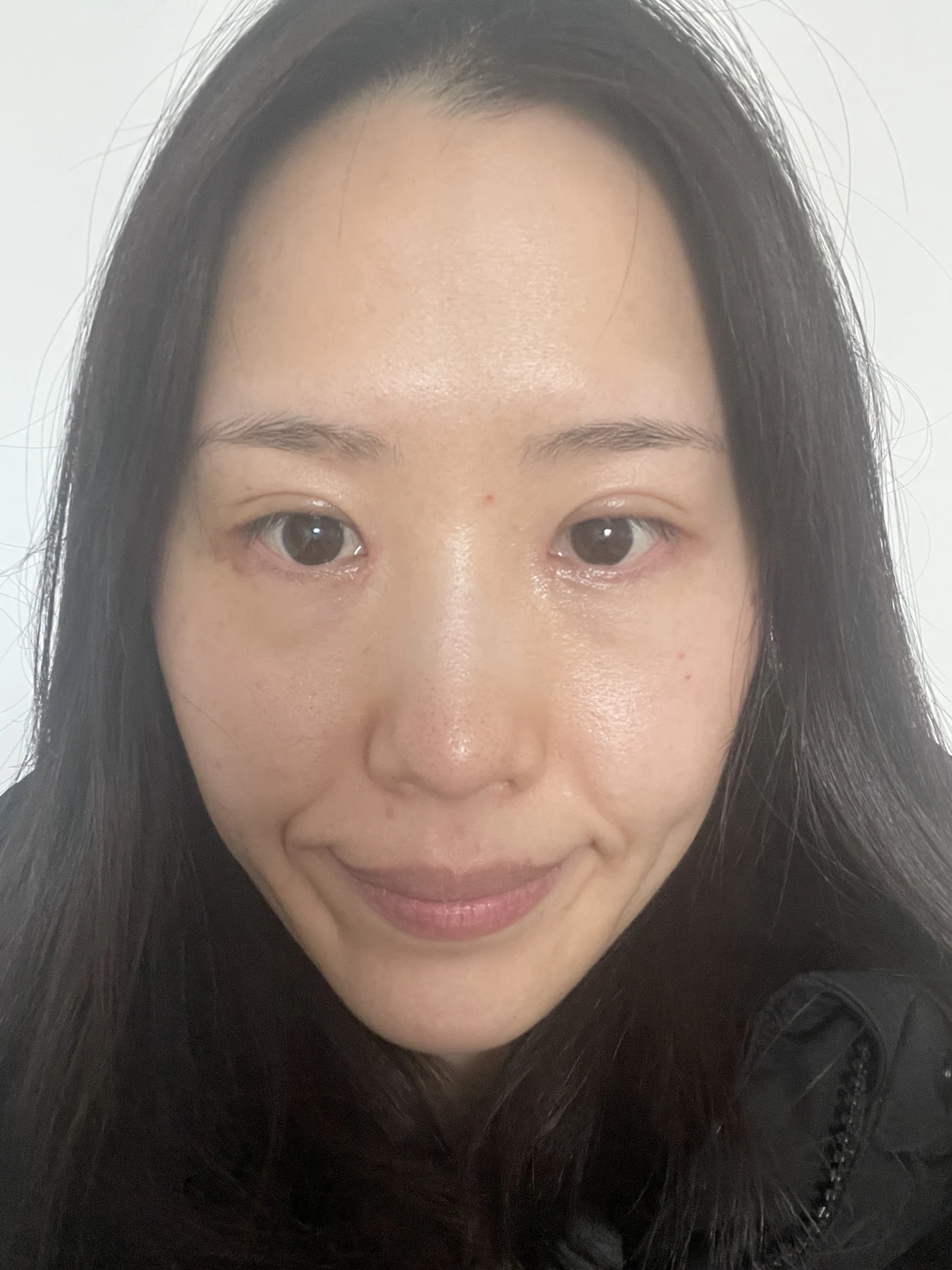 Eye-area surgery for a drooping-eyelid concern: six-month photographs · Case 084 at Answer Plastic Surgery. Front view — 2 weeks after surgery, eye-area surgery for a drooping-eyelid concern at Answer Plastic Surgery (case 084).