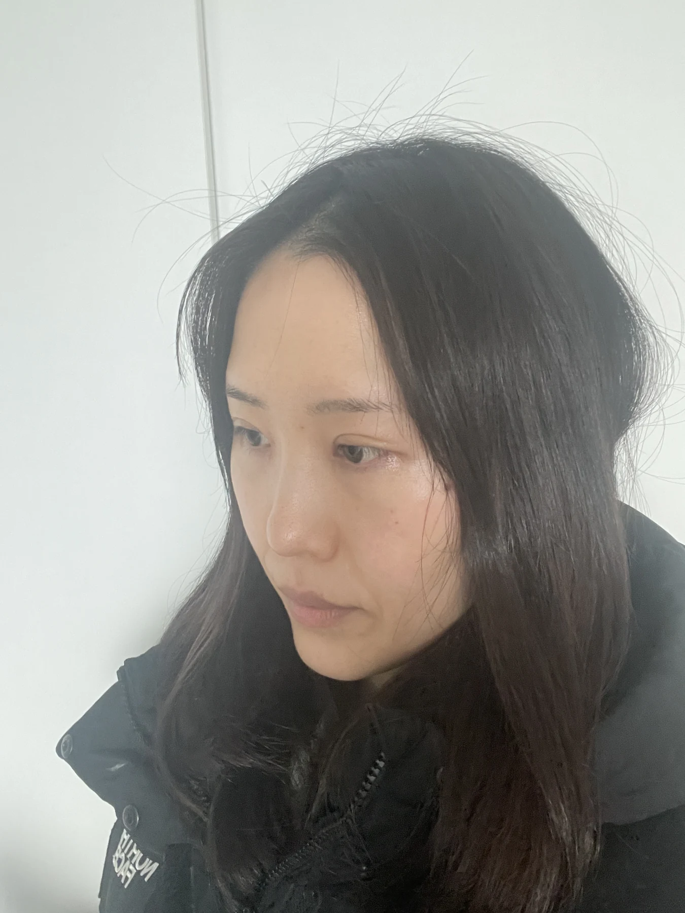 Eye-area surgery for a drooping-eyelid concern: six-month photographs · Case 084 at Answer Plastic Surgery. Opposite oblique view — 2 weeks after surgery, eye-area surgery for a drooping-eyelid concern at Answer Plastic Surgery (case 084).