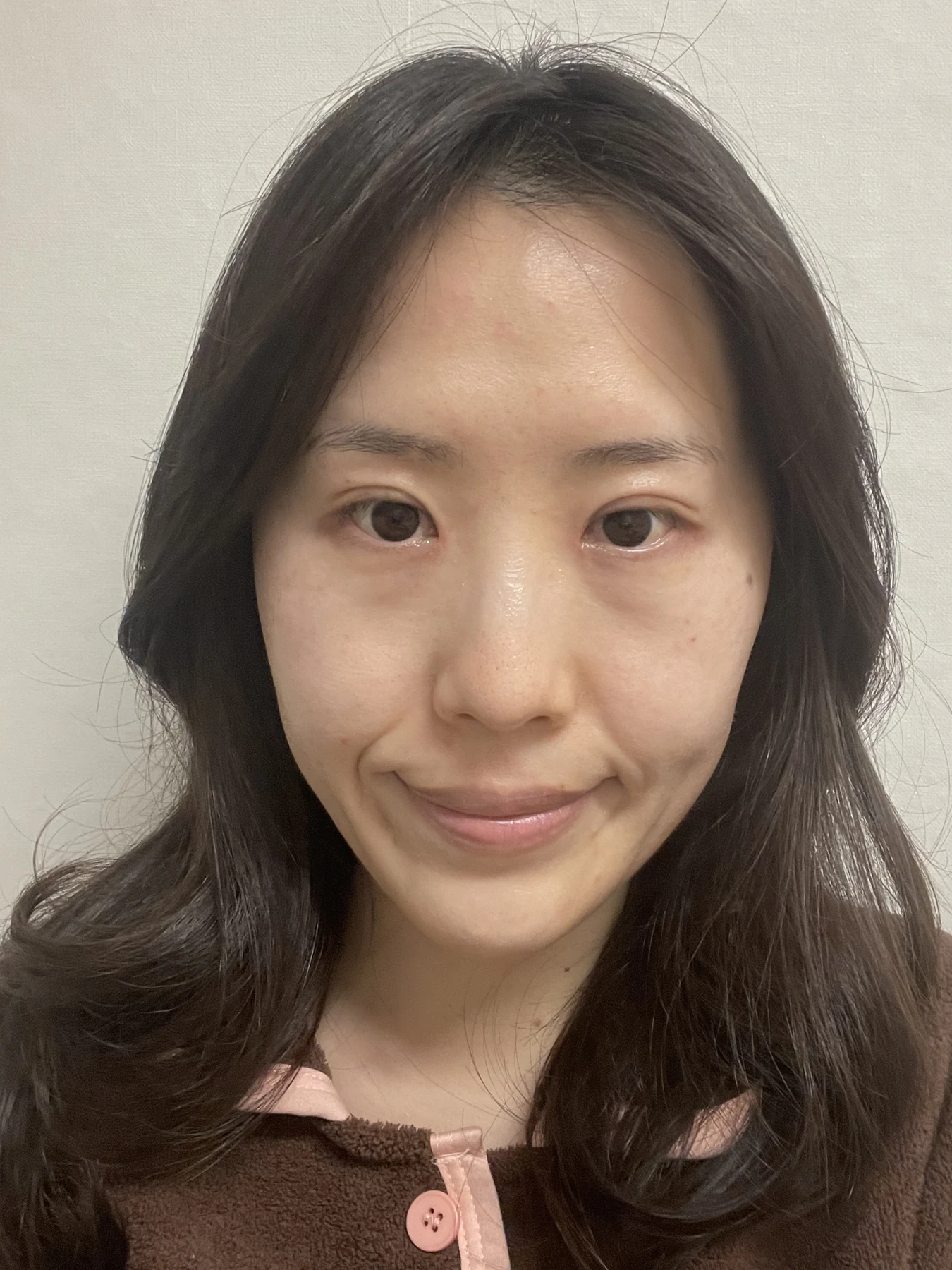 Eye-area surgery for a drooping-eyelid concern: six-month photographs · Case 084 at Answer Plastic Surgery. Front view — 1 month after surgery, eye-area surgery for a drooping-eyelid concern at Answer Plastic Surgery (case 084).