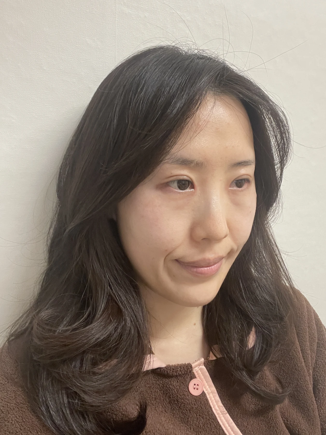 Eye-area surgery for a drooping-eyelid concern: six-month photographs · Case 084 at Answer Plastic Surgery. Oblique view — 1 month after surgery, eye-area surgery for a drooping-eyelid concern at Answer Plastic Surgery (case 084).