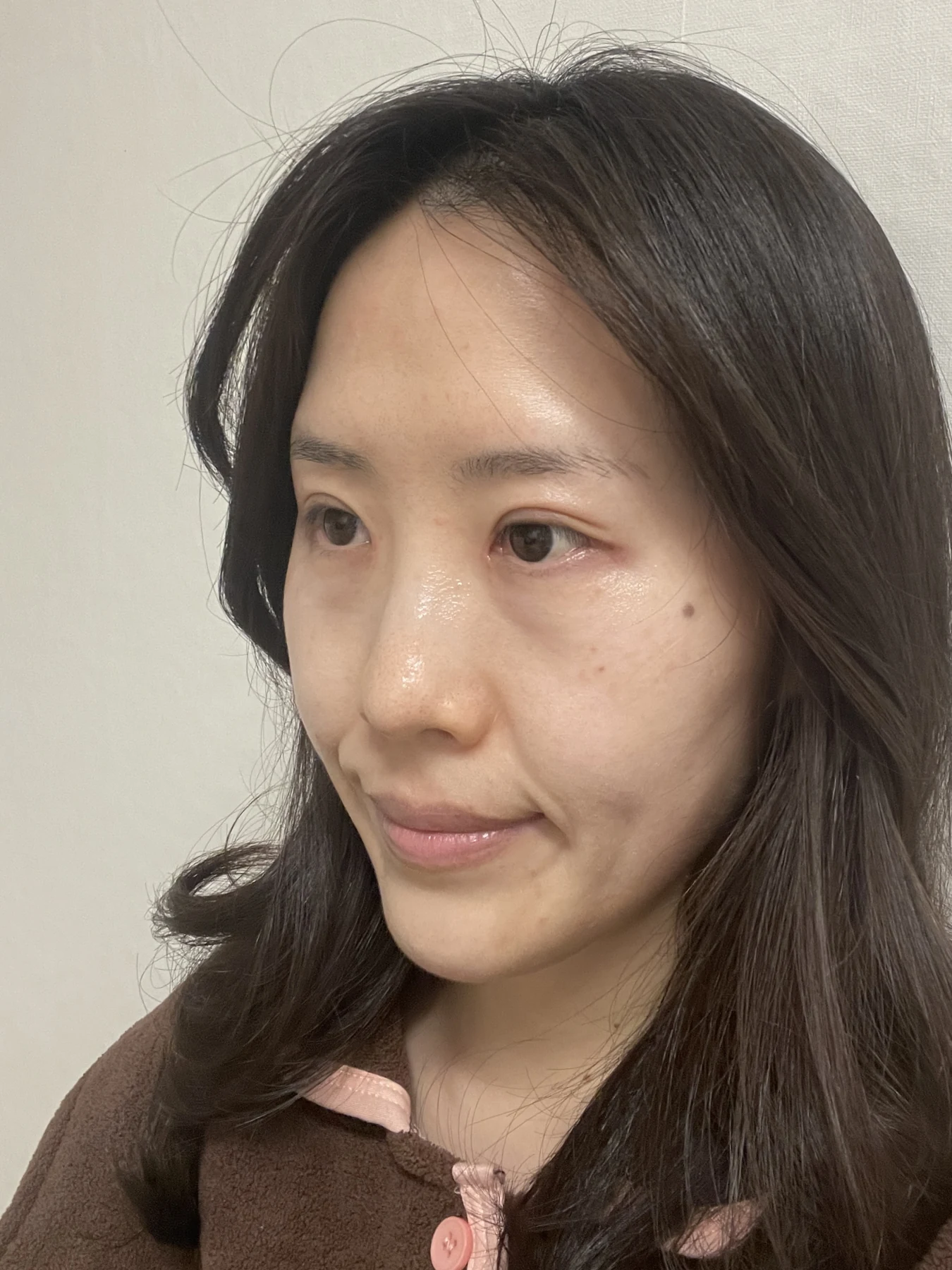 Eye-area surgery for a drooping-eyelid concern: six-month photographs · Case 084 at Answer Plastic Surgery. Opposite oblique view — 1 month after surgery, eye-area surgery for a drooping-eyelid concern at Answer Plastic Surgery (case 084).
