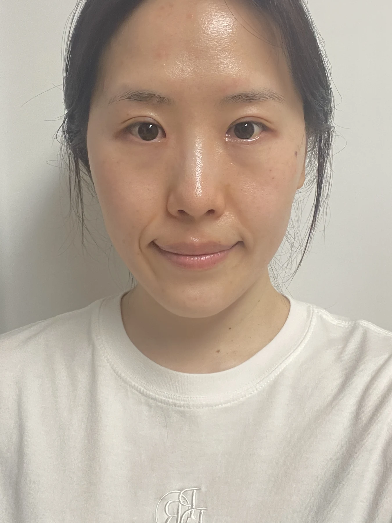 Eye-area surgery for a drooping-eyelid concern: six-month photographs · Case 084 at Answer Plastic Surgery. Front view — 2 months after surgery, eye-area surgery for a drooping-eyelid concern at Answer Plastic Surgery (case 084).