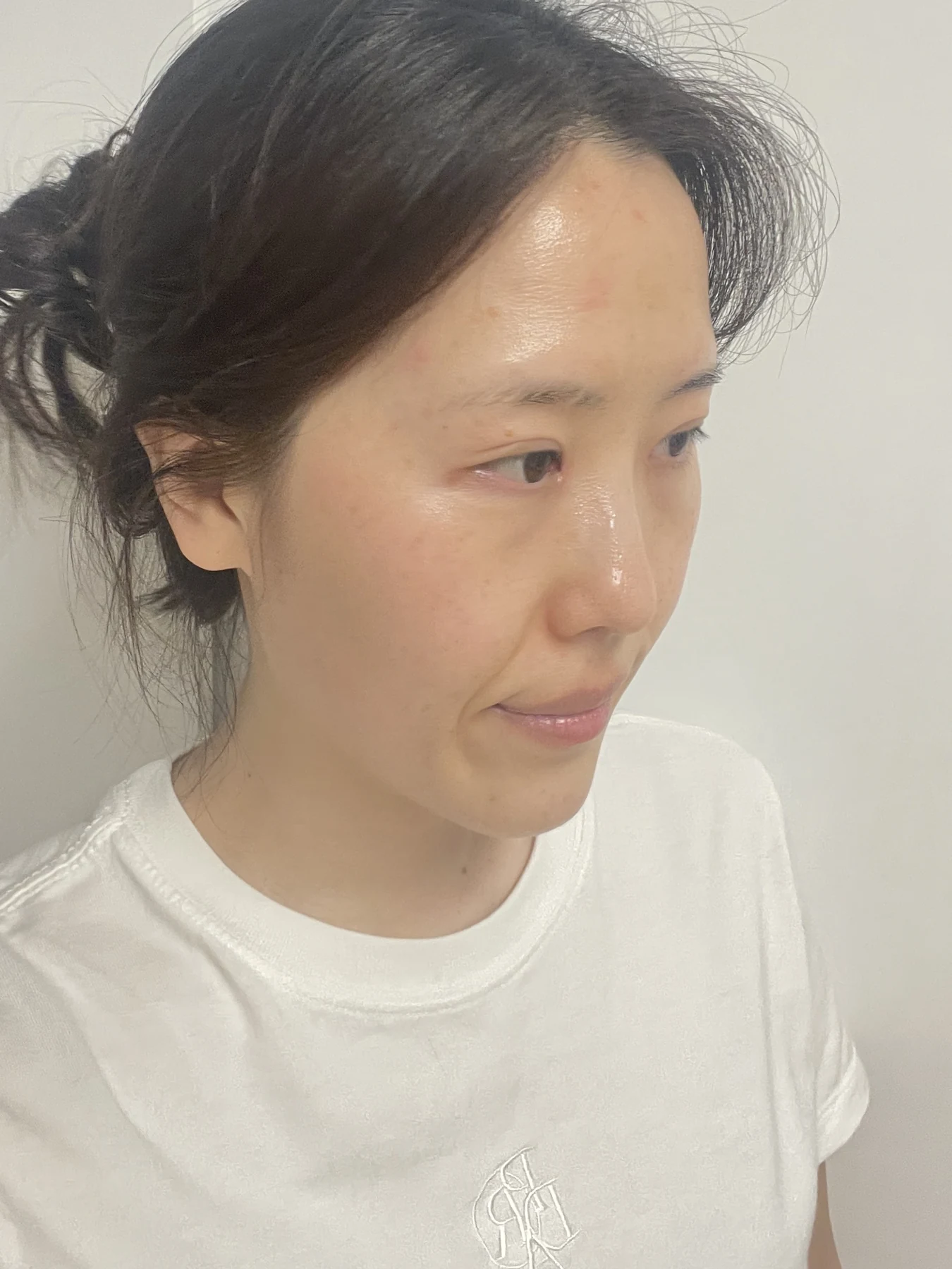 Eye-area surgery for a drooping-eyelid concern: six-month photographs · Case 084 at Answer Plastic Surgery. Oblique view — 2 months after surgery, eye-area surgery for a drooping-eyelid concern at Answer Plastic Surgery (case 084).