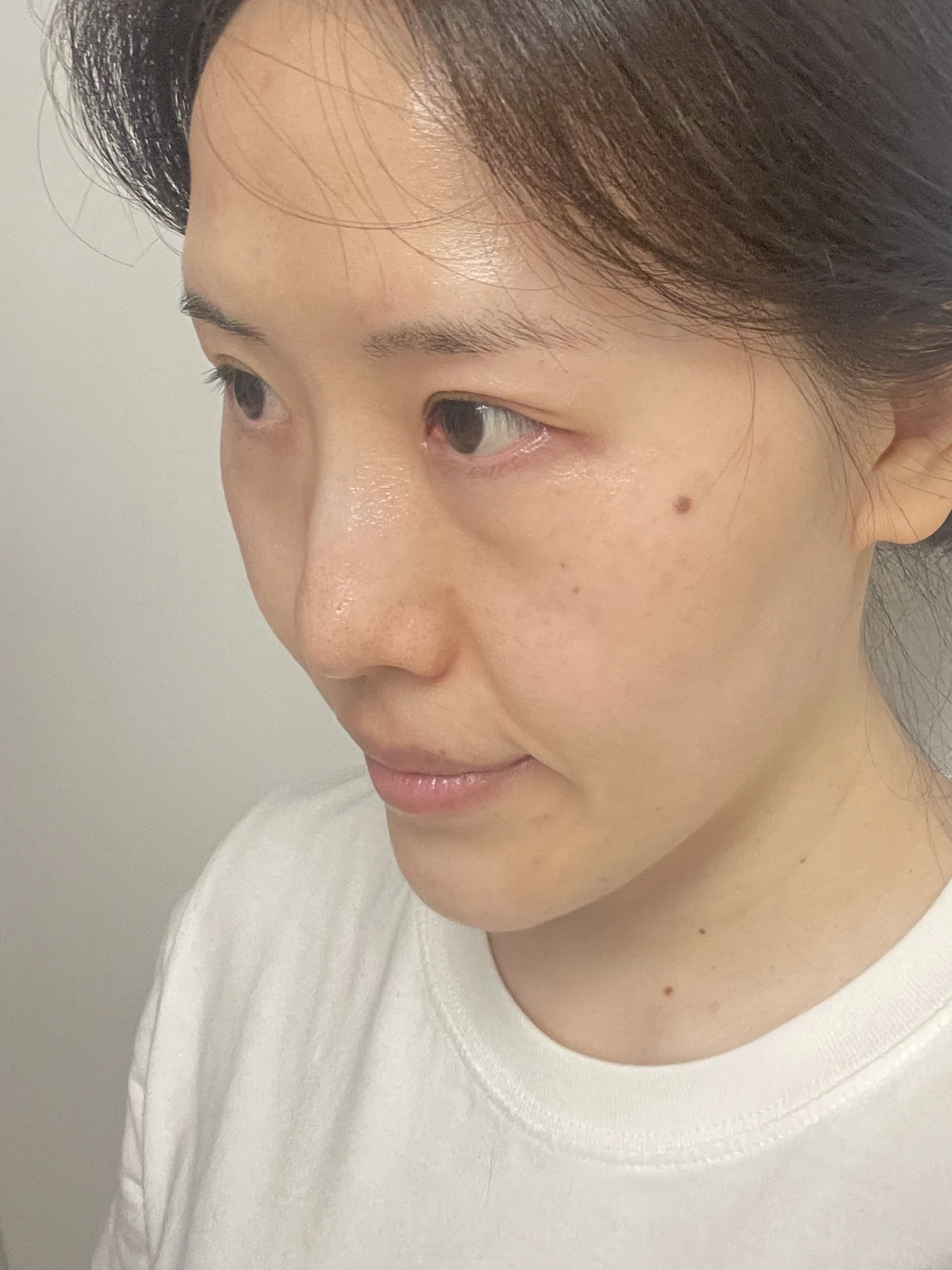 Eye-area surgery for a drooping-eyelid concern: six-month photographs · Case 084 at Answer Plastic Surgery. Opposite oblique view — 2 months after surgery, eye-area surgery for a drooping-eyelid concern at Answer Plastic Surgery (case 084).