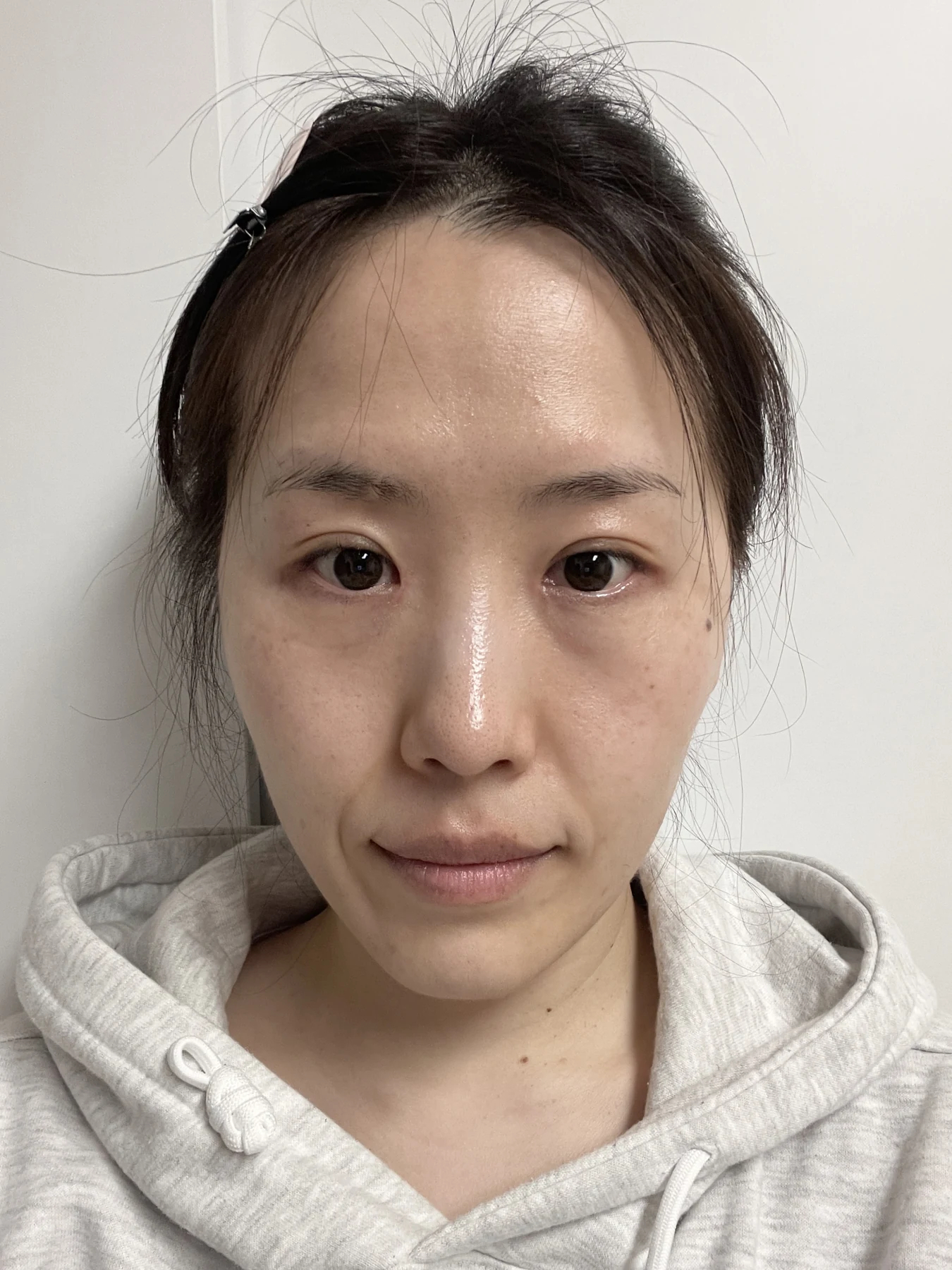 Eye-area surgery for a drooping-eyelid concern: six-month photographs · Case 084 at Answer Plastic Surgery. Front view — 3 months after surgery, eye-area surgery for a drooping-eyelid concern at Answer Plastic Surgery (case 084).