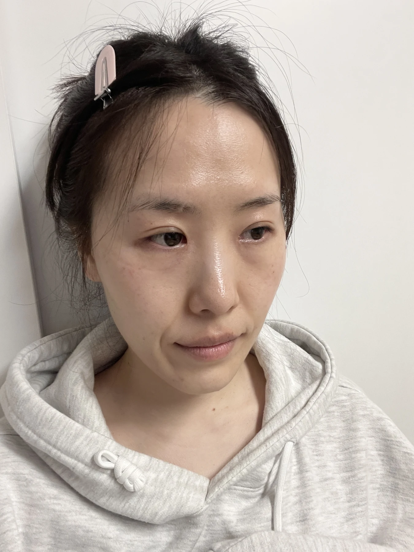 Eye-area surgery for a drooping-eyelid concern: six-month photographs · Case 084 at Answer Plastic Surgery. Oblique view — 3 months after surgery, eye-area surgery for a drooping-eyelid concern at Answer Plastic Surgery (case 084).