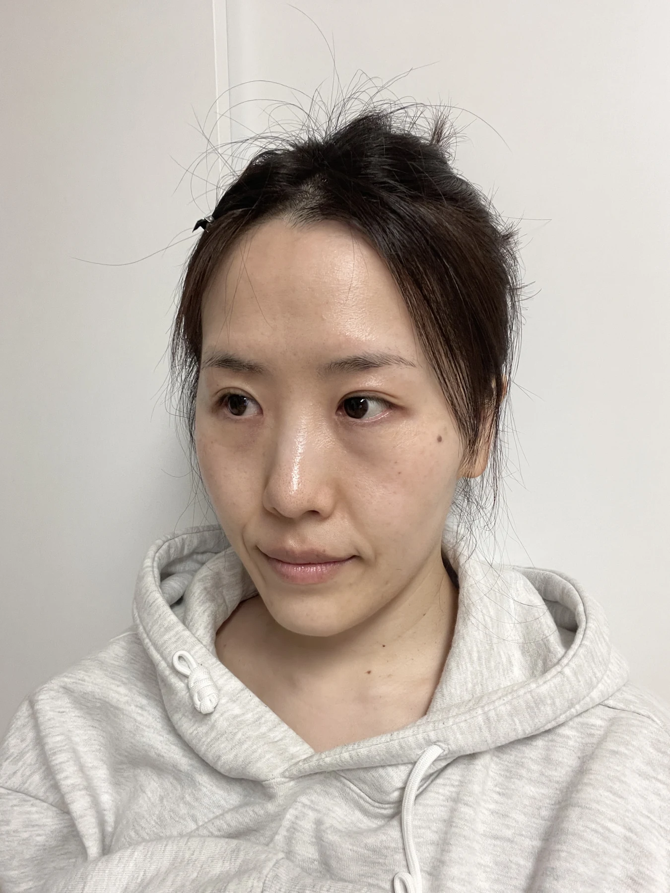 Eye-area surgery for a drooping-eyelid concern: six-month photographs · Case 084 at Answer Plastic Surgery. Opposite oblique view — 3 months after surgery, eye-area surgery for a drooping-eyelid concern at Answer Plastic Surgery (case 084).