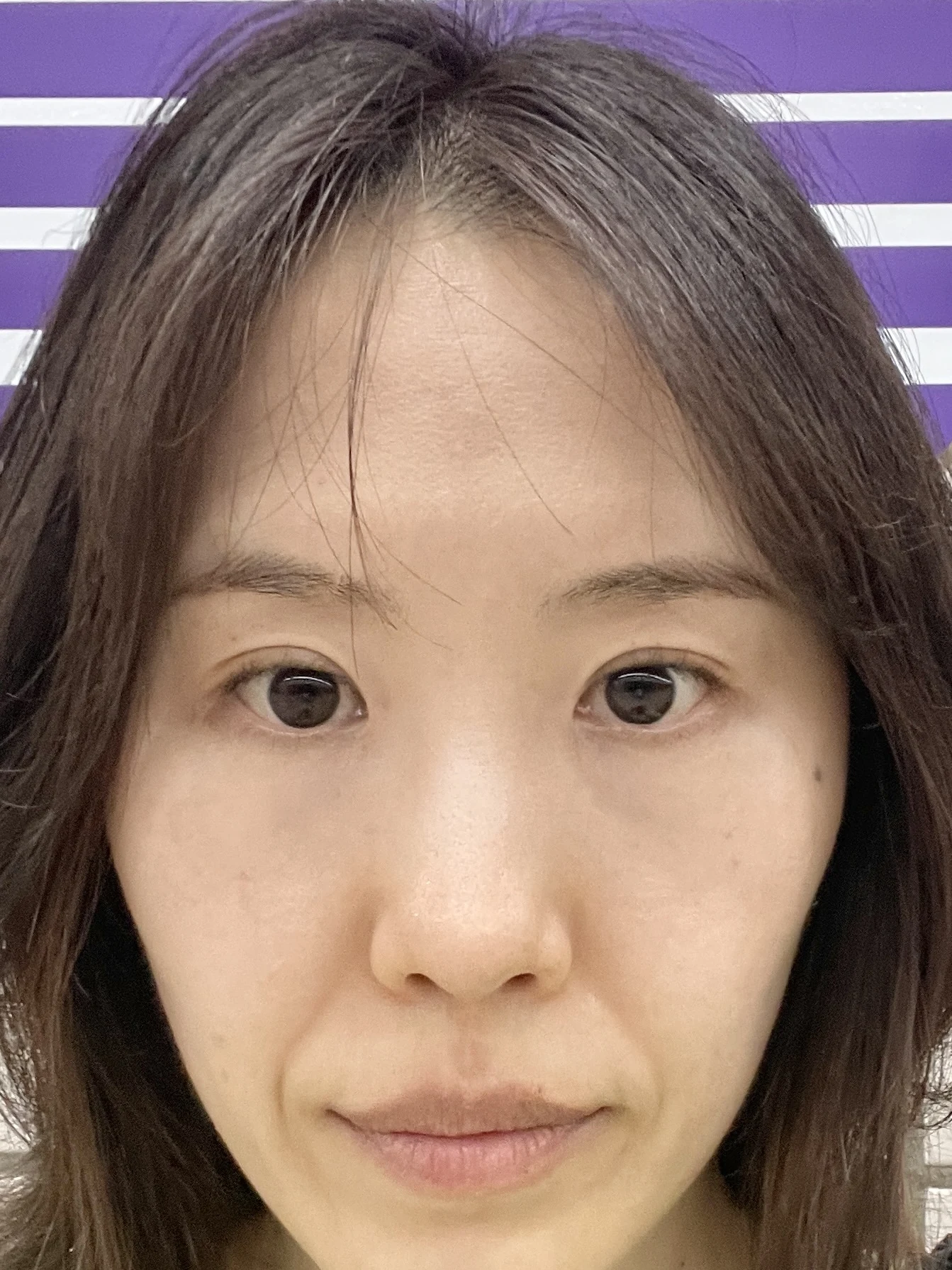Eye-area surgery for a drooping-eyelid concern: six-month photographs · Case 084 at Answer Plastic Surgery. Front view — 6 months after surgery, eye-area surgery for a drooping-eyelid concern at Answer Plastic Surgery (case 084).