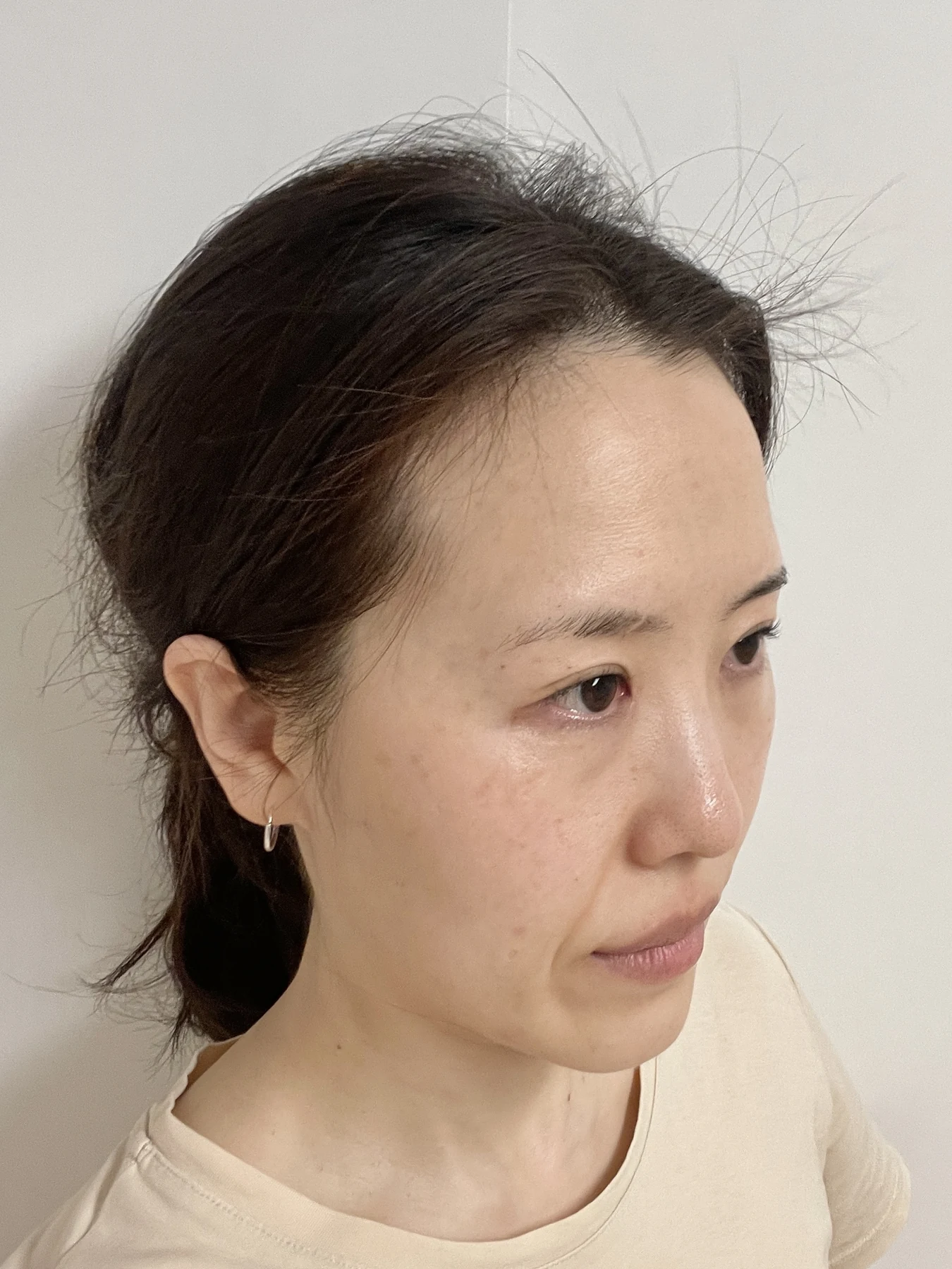 Eye-area surgery for a drooping-eyelid concern: six-month photographs · Case 084 at Answer Plastic Surgery. Oblique view — 6 months after surgery, eye-area surgery for a drooping-eyelid concern at Answer Plastic Surgery (case 084).