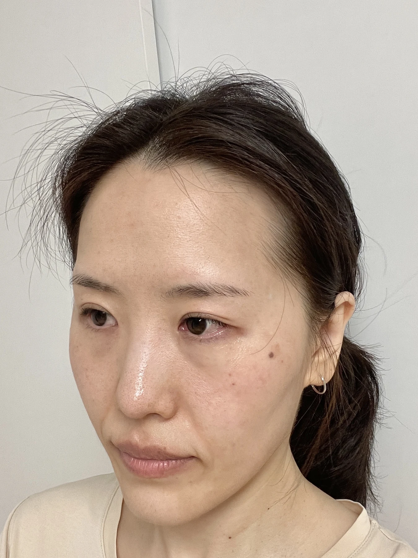 Eye-area surgery for a drooping-eyelid concern: six-month photographs · Case 084 at Answer Plastic Surgery. Opposite oblique view — 6 months after surgery, eye-area surgery for a drooping-eyelid concern at Answer Plastic Surgery (case 084).