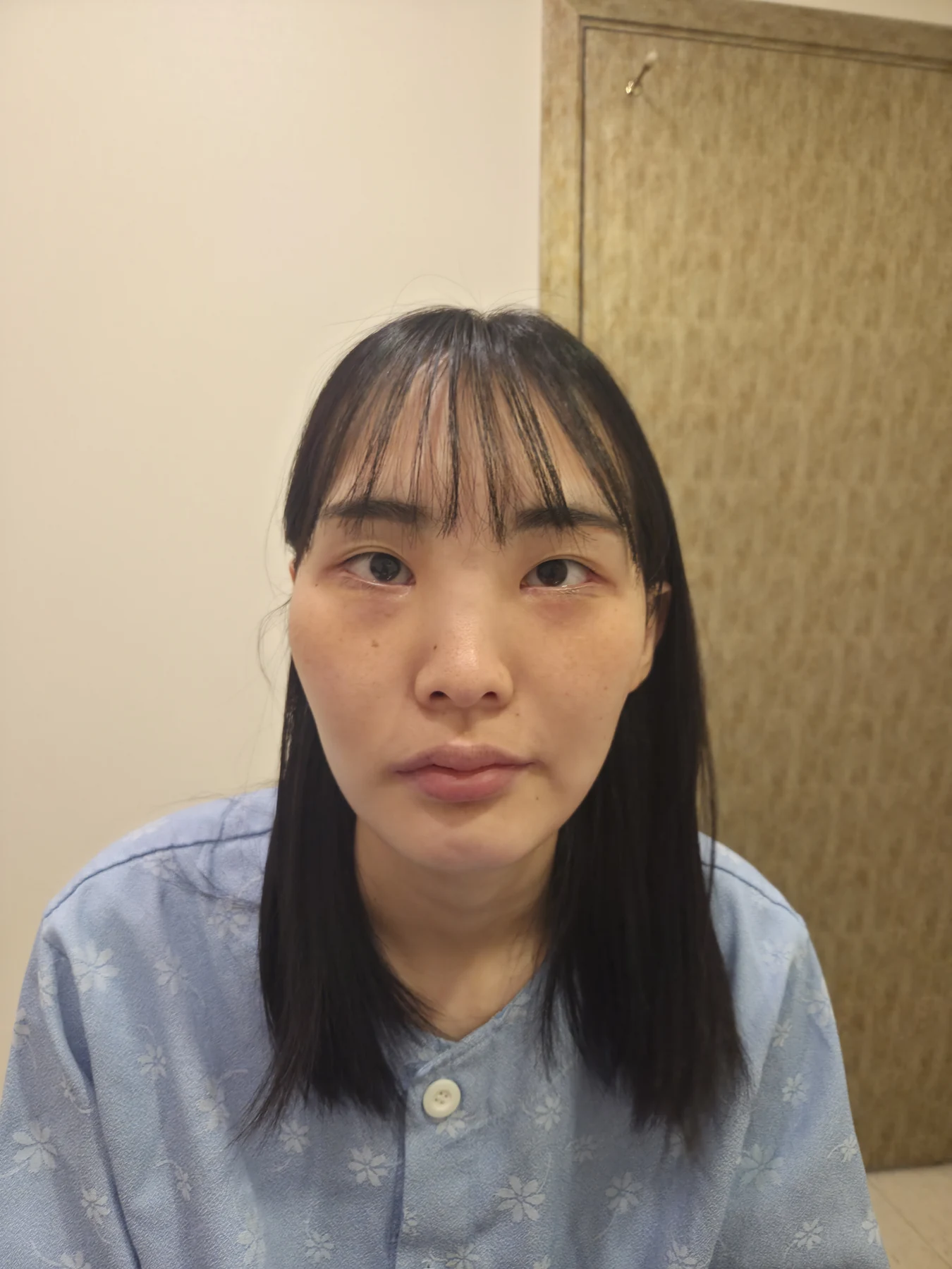Eye-opening correction: photographs through six months · Case 085 at Answer Plastic Surgery. Front view — before, eye-opening correction at Answer Plastic Surgery (case 085).