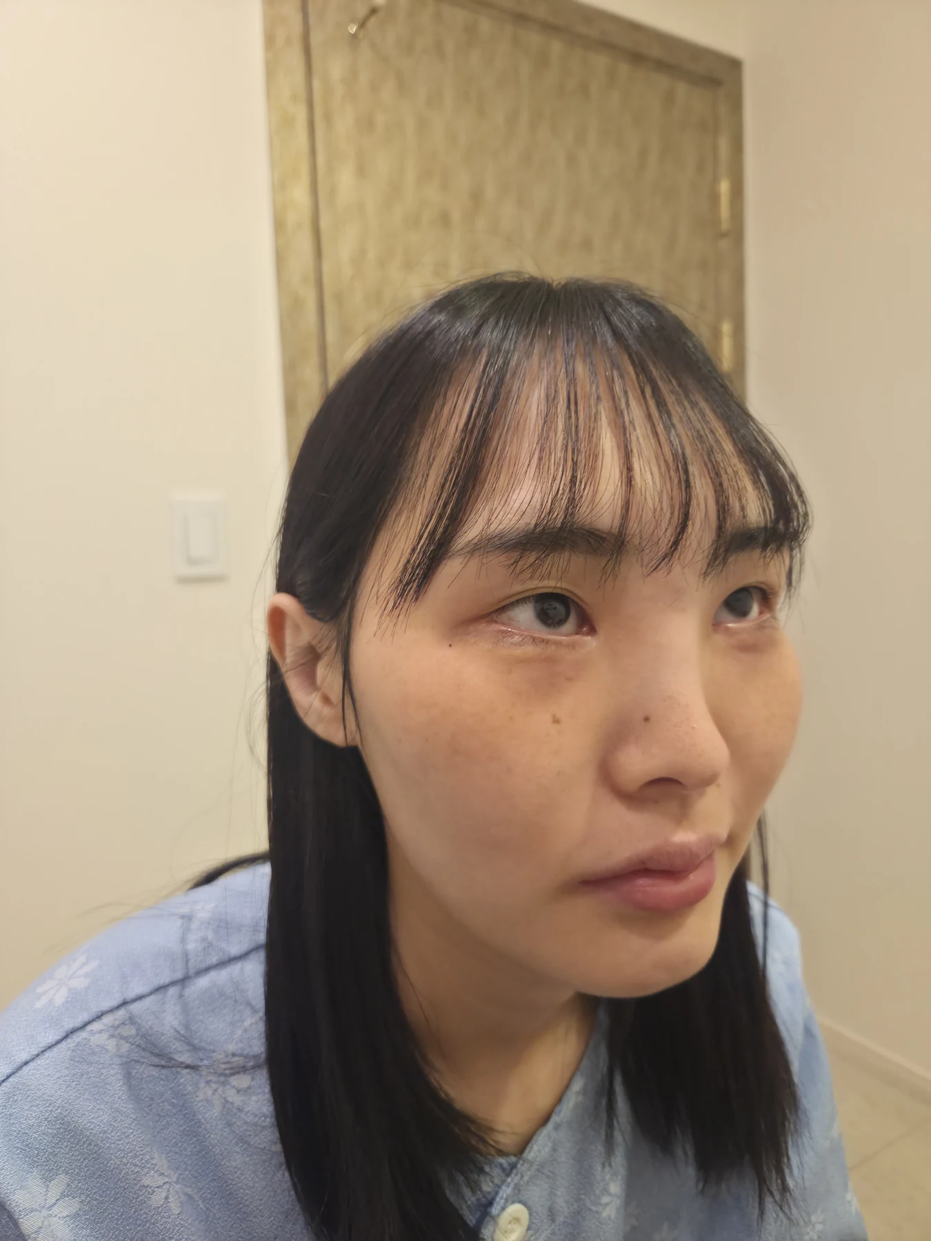 Eye-opening correction: photographs through six months · Case 085 at Answer Plastic Surgery. Oblique view — before, eye-opening correction at Answer Plastic Surgery (case 085).