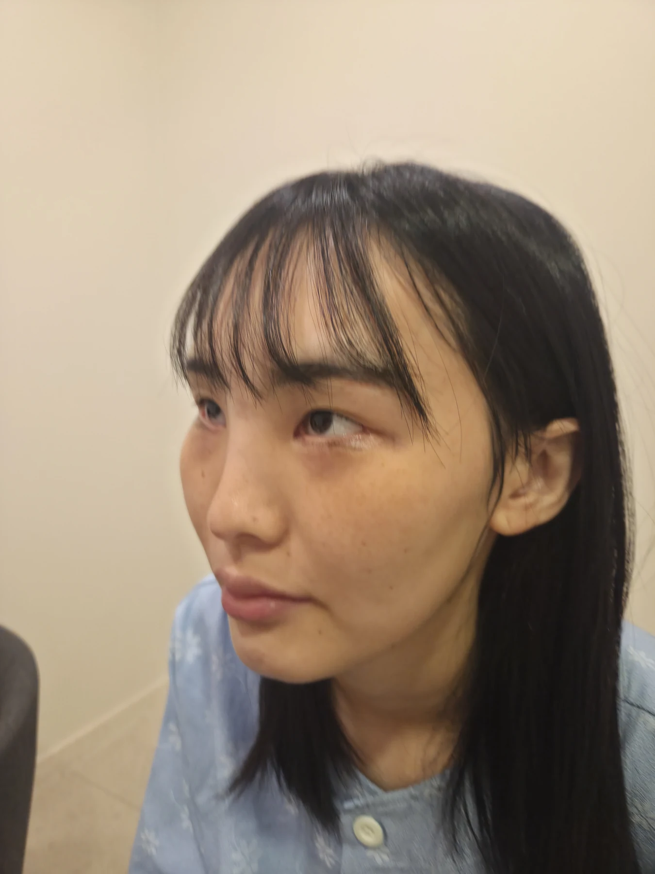 Eye-opening correction: photographs through six months · Case 085 at Answer Plastic Surgery. Opposite oblique view — before, eye-opening correction at Answer Plastic Surgery (case 085).