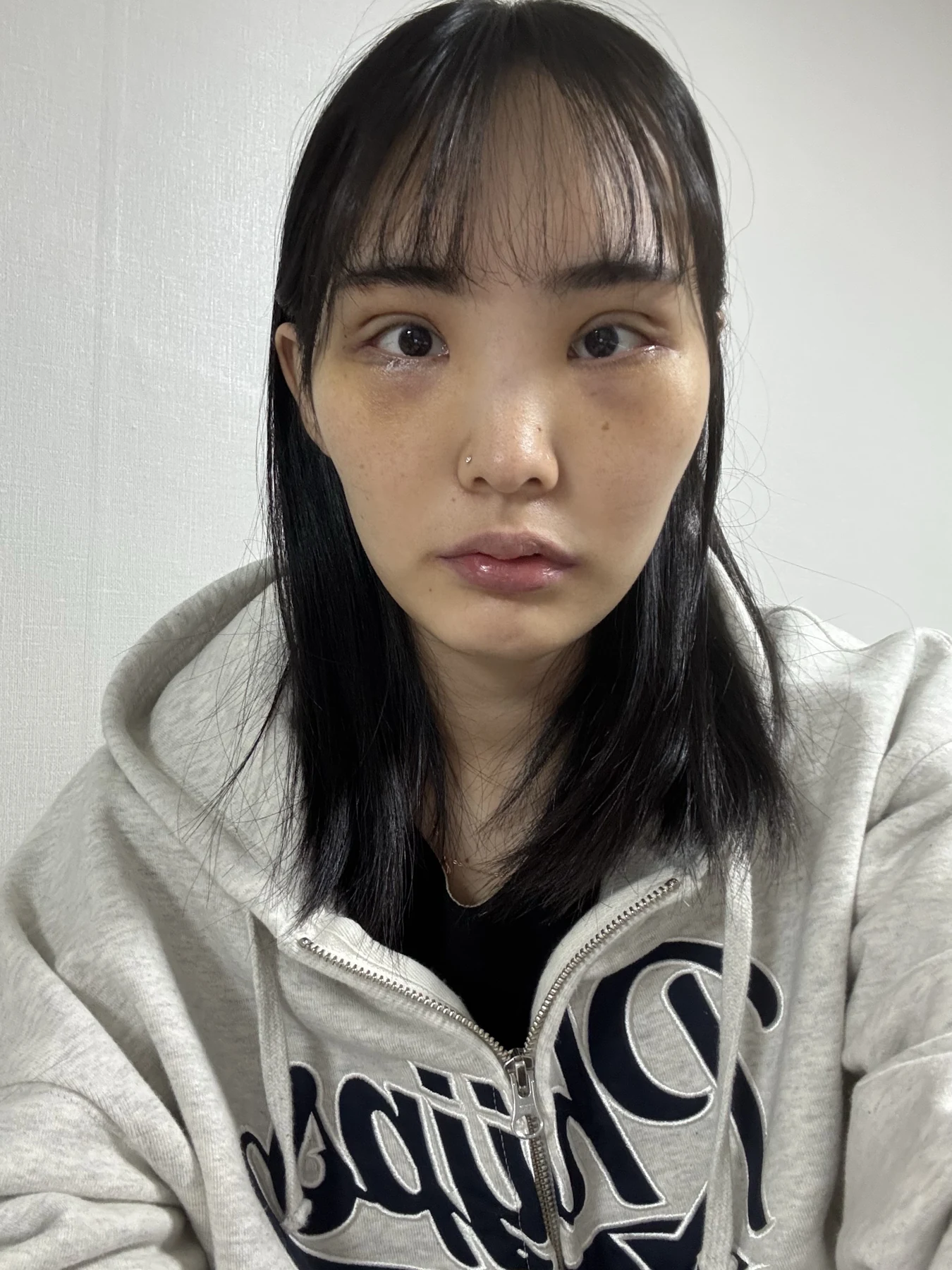 Eye-opening correction: photographs through six months · Case 085 at Answer Plastic Surgery. Front view — 1 week after surgery, eye-opening correction at Answer Plastic Surgery (case 085).
