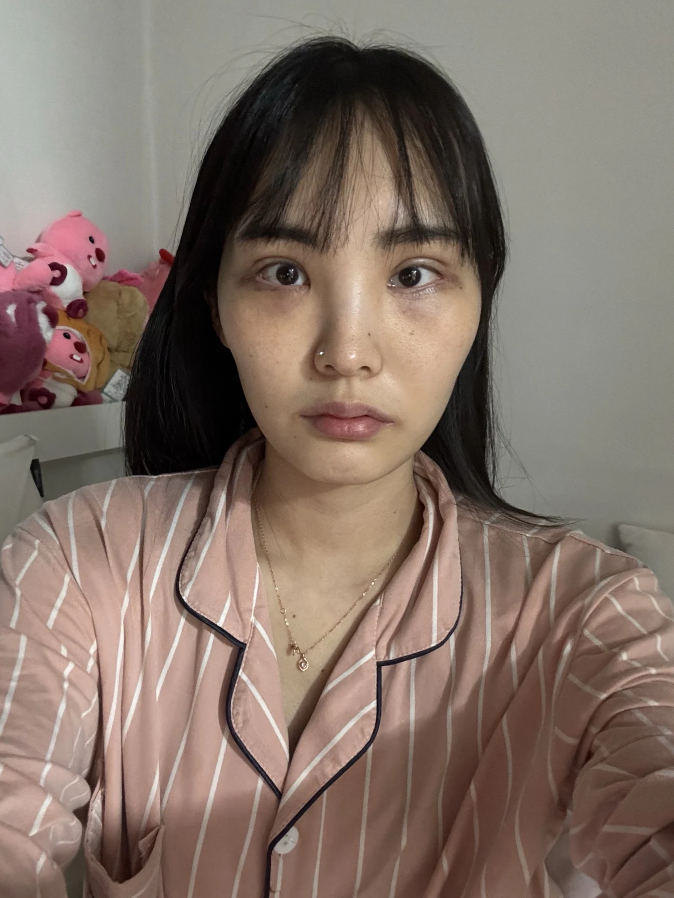 Eye-opening correction: photographs through six months · Case 085 at Answer Plastic Surgery. Front view — 2 weeks after surgery, eye-opening correction at Answer Plastic Surgery (case 085).