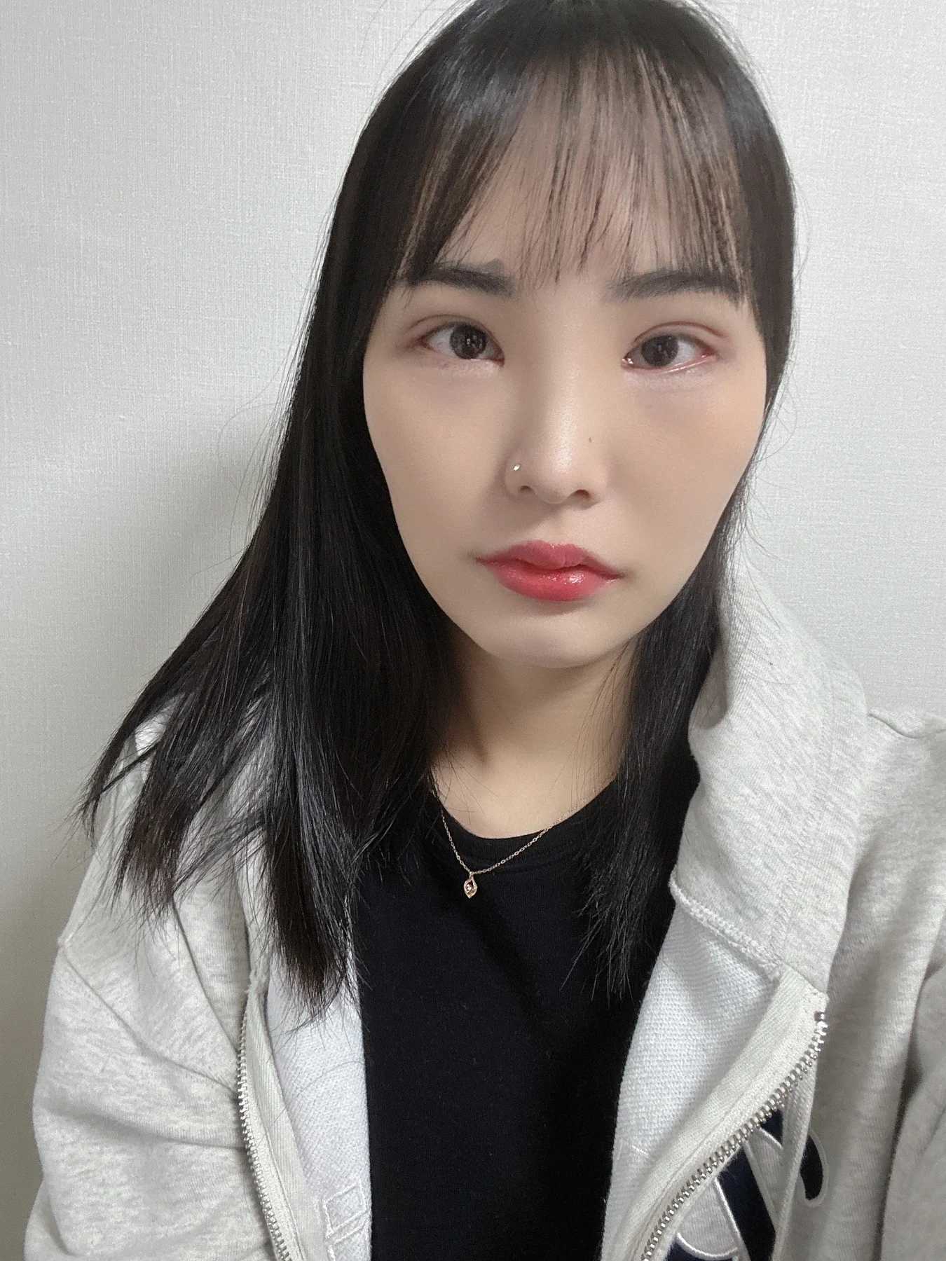 Eye-opening correction: photographs through six months · Case 085 at Answer Plastic Surgery. Front view — 3 weeks after surgery, eye-opening correction at Answer Plastic Surgery (case 085).