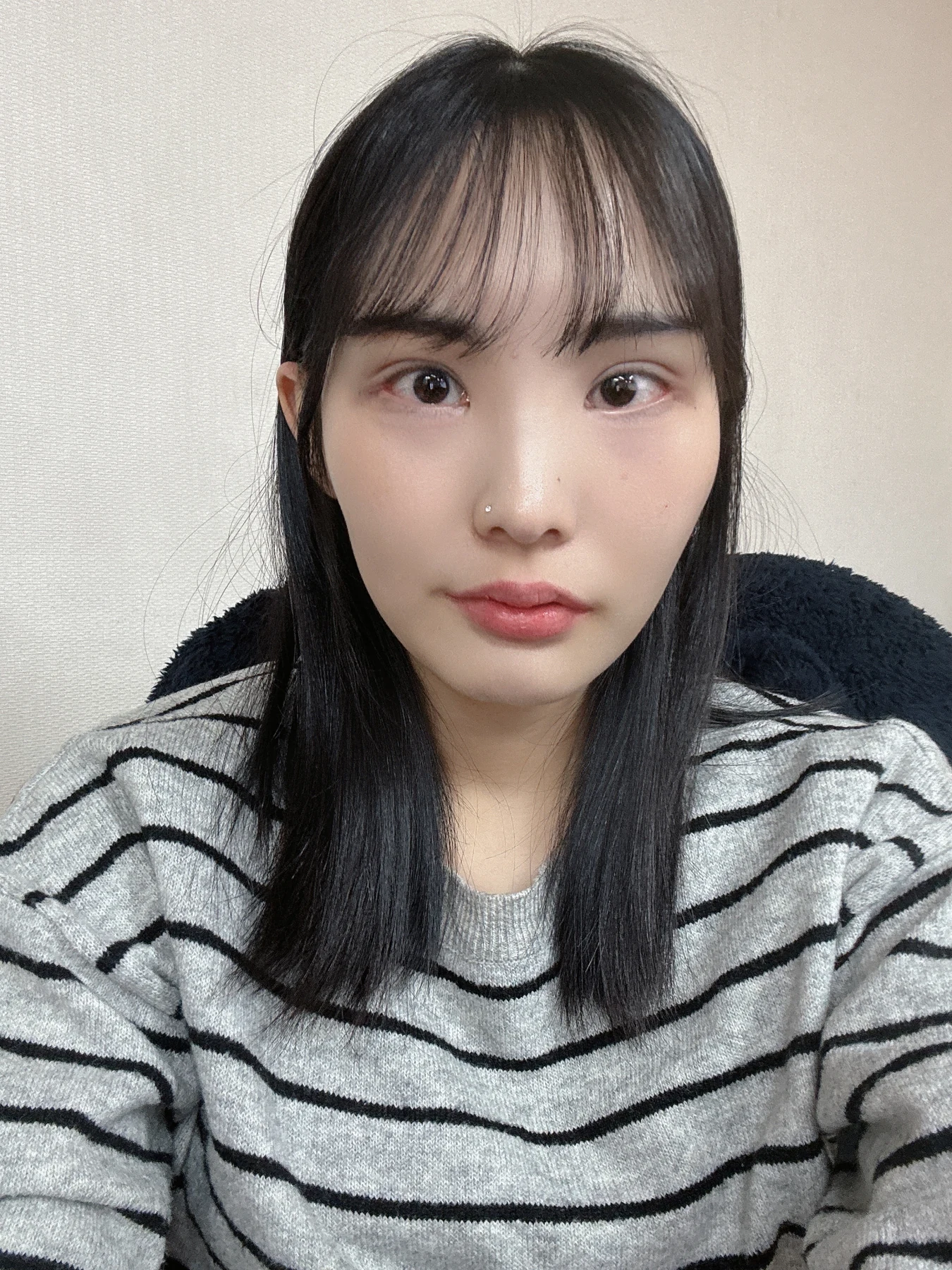 Eye-opening correction: photographs through six months · Case 085 at Answer Plastic Surgery. Front view — 1 month after surgery, eye-opening correction at Answer Plastic Surgery (case 085).