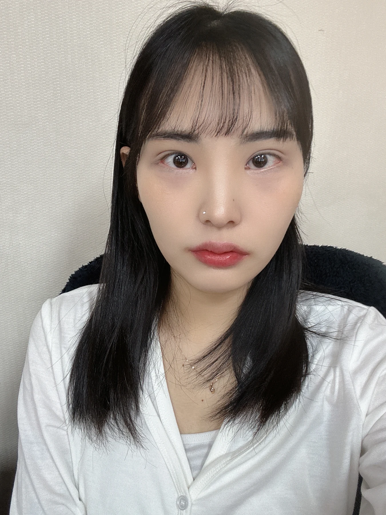 Eye-opening correction: photographs through six months · Case 085 at Answer Plastic Surgery. Front view — 2 months after surgery, eye-opening correction at Answer Plastic Surgery (case 085).