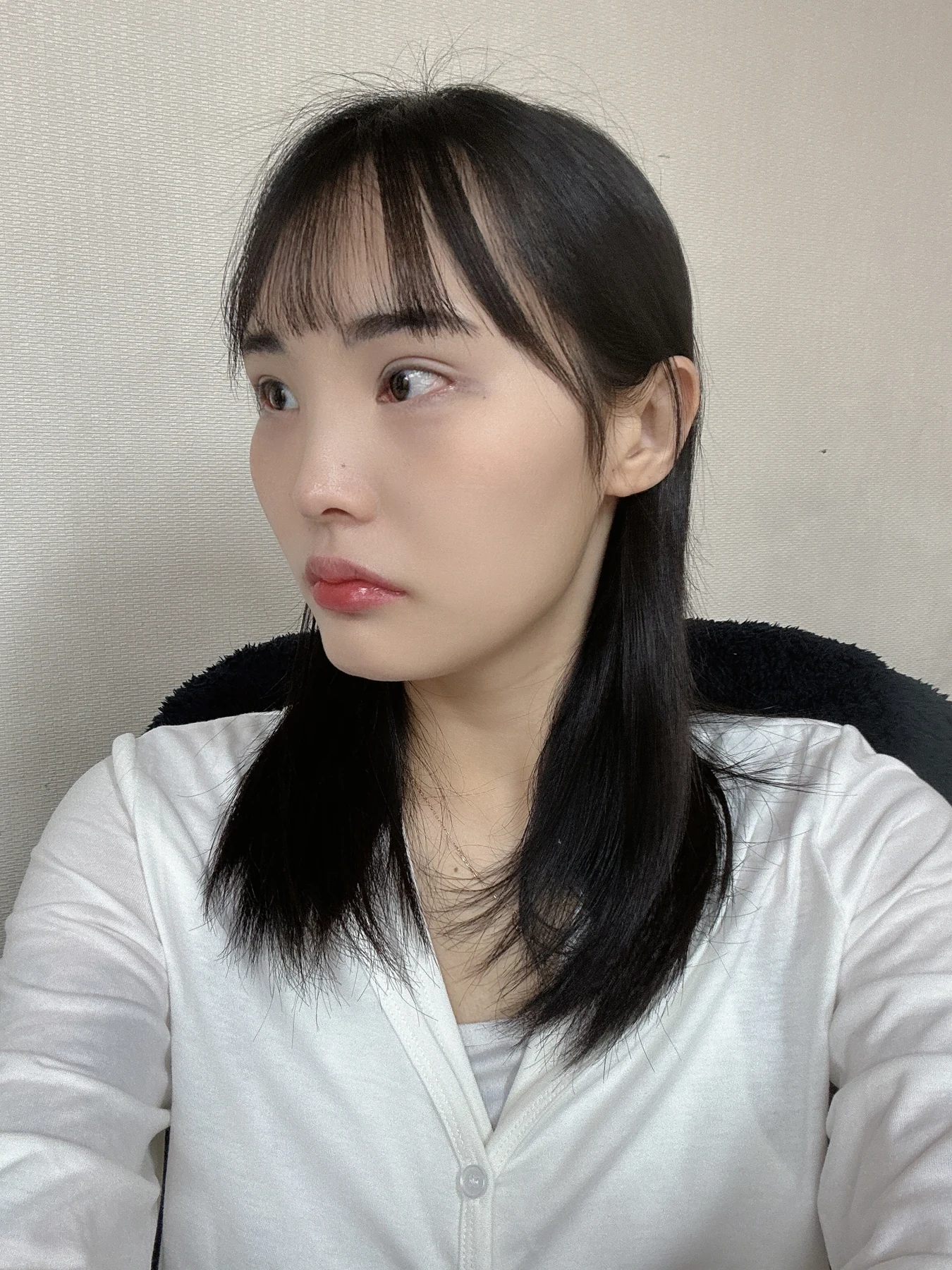 Eye-opening correction: photographs through six months · Case 085 at Answer Plastic Surgery. Opposite oblique view — 2 months after surgery, eye-opening correction at Answer Plastic Surgery (case 085).