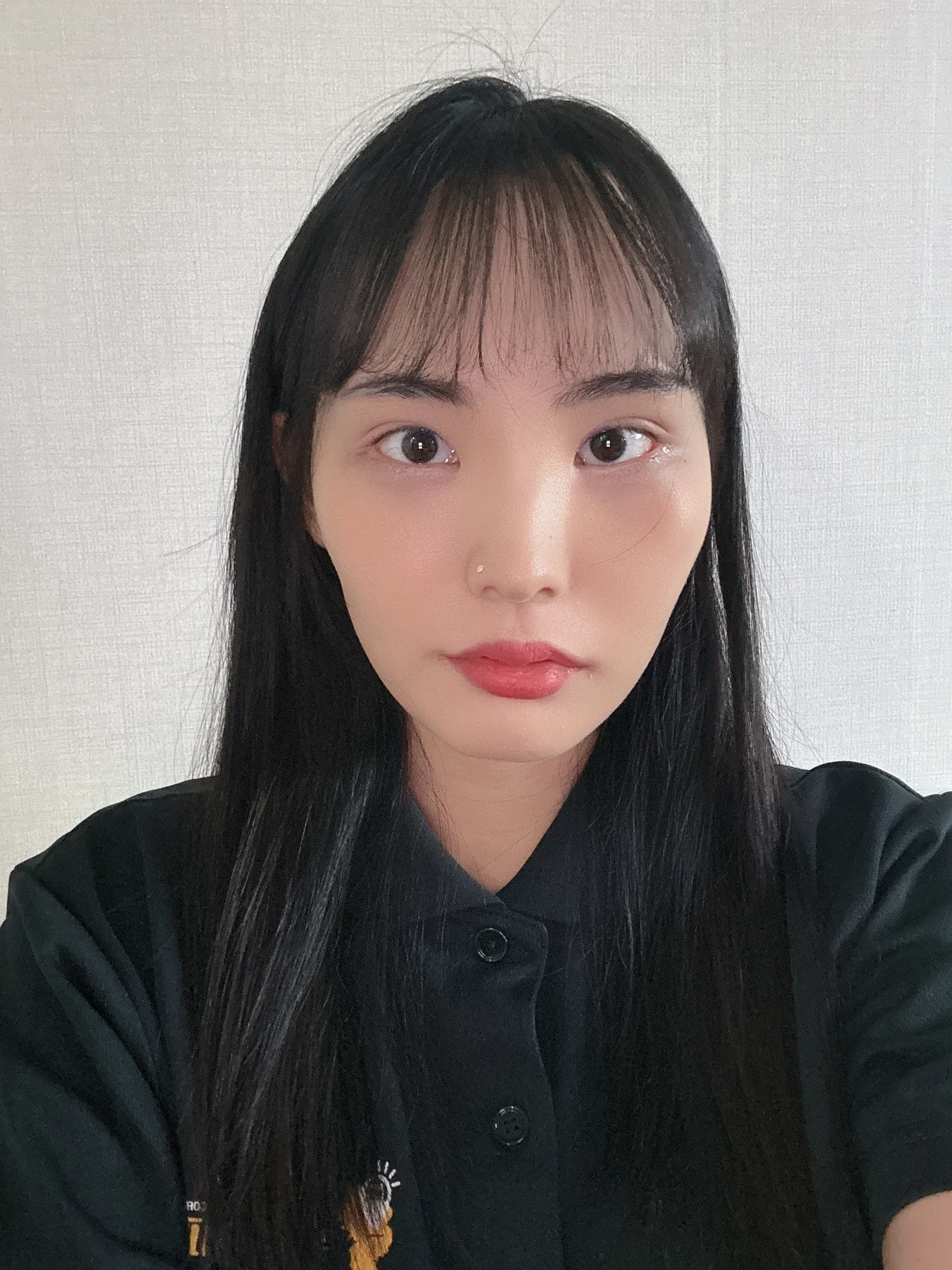 Eye-opening correction: photographs through six months · Case 085 at Answer Plastic Surgery. Front view — 6 months after surgery, eye-opening correction at Answer Plastic Surgery (case 085).