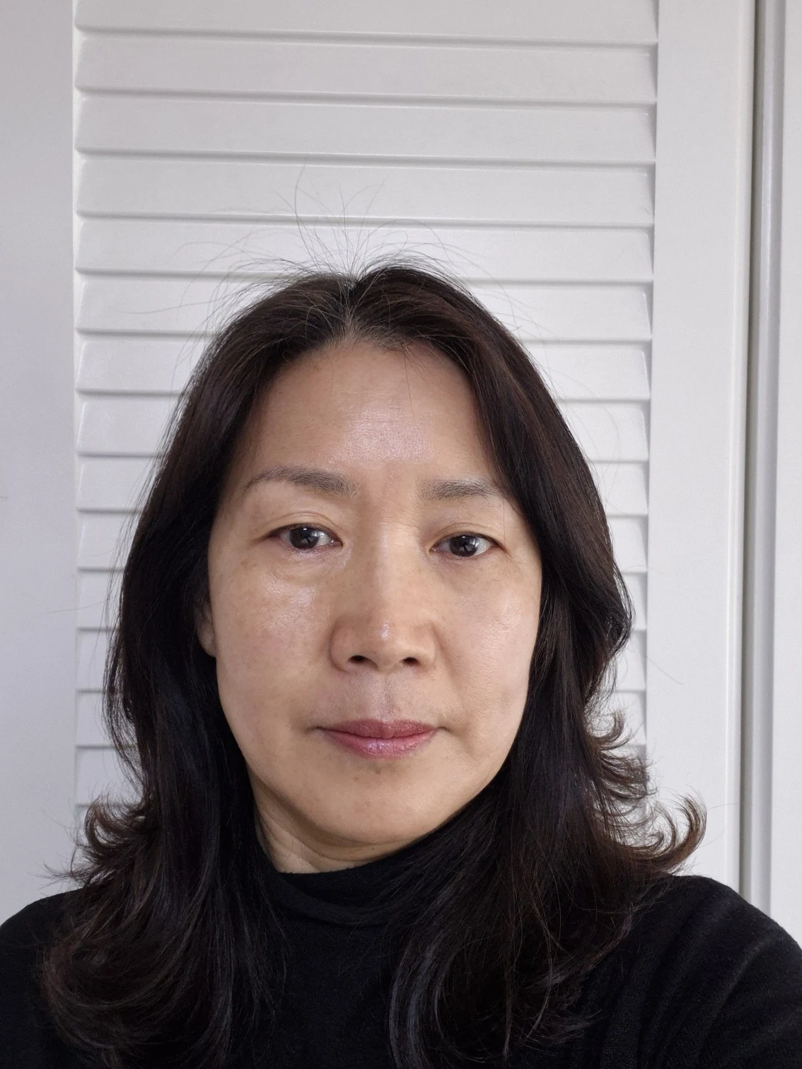 Sub-brow lift: recovery photographs through six months · Case 086 at Answer Plastic Surgery. Front view — before, sub-brow lift at Answer Plastic Surgery (case 086).