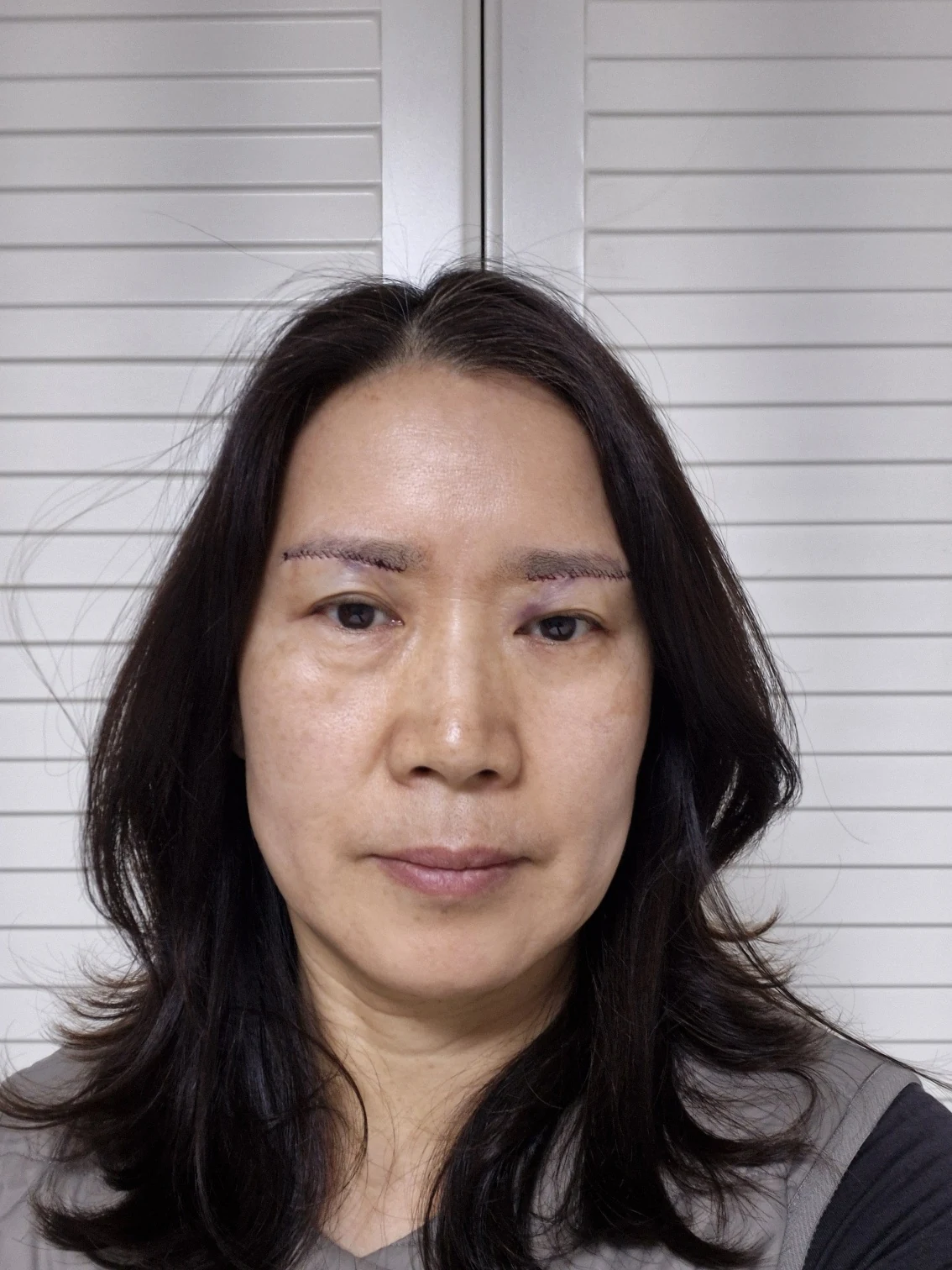 Sub-brow lift: recovery photographs through six months · Case 086 at Answer Plastic Surgery. Front view — surgery day, sub-brow lift at Answer Plastic Surgery (case 086).