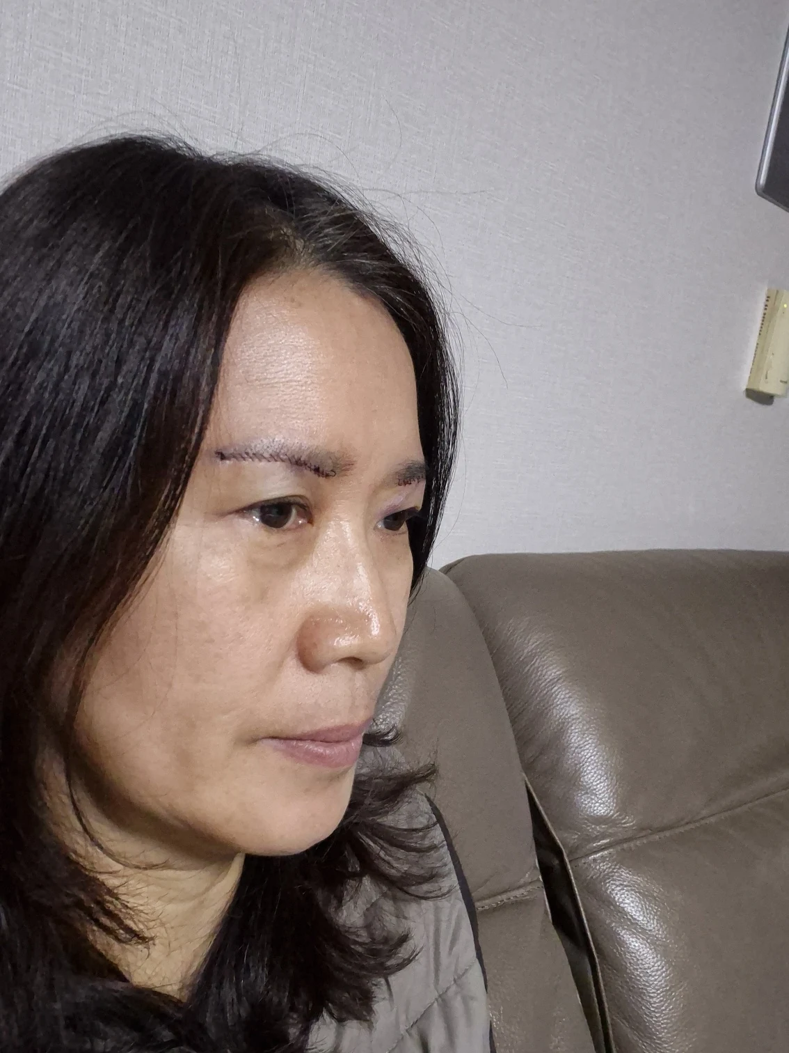 Sub-brow lift: recovery photographs through six months · Case 086 at Answer Plastic Surgery. Oblique view — surgery day, sub-brow lift at Answer Plastic Surgery (case 086).