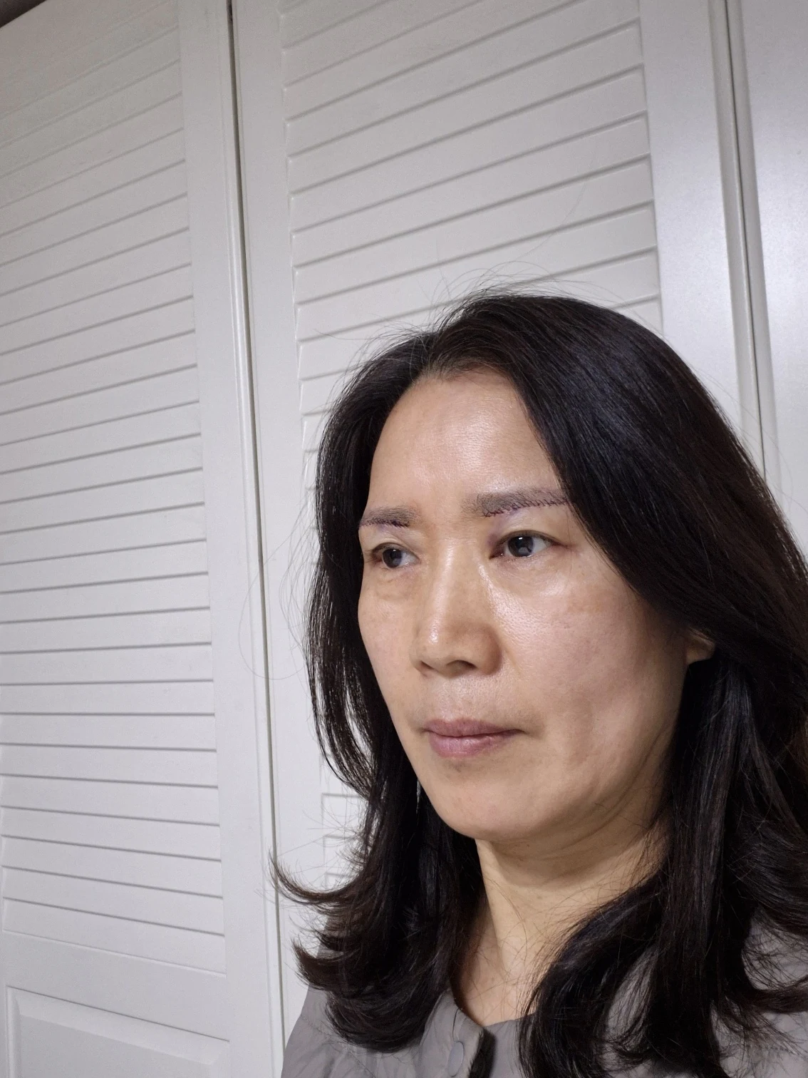 Sub-brow lift: recovery photographs through six months · Case 086 at Answer Plastic Surgery. Opposite oblique view — surgery day, sub-brow lift at Answer Plastic Surgery (case 086).