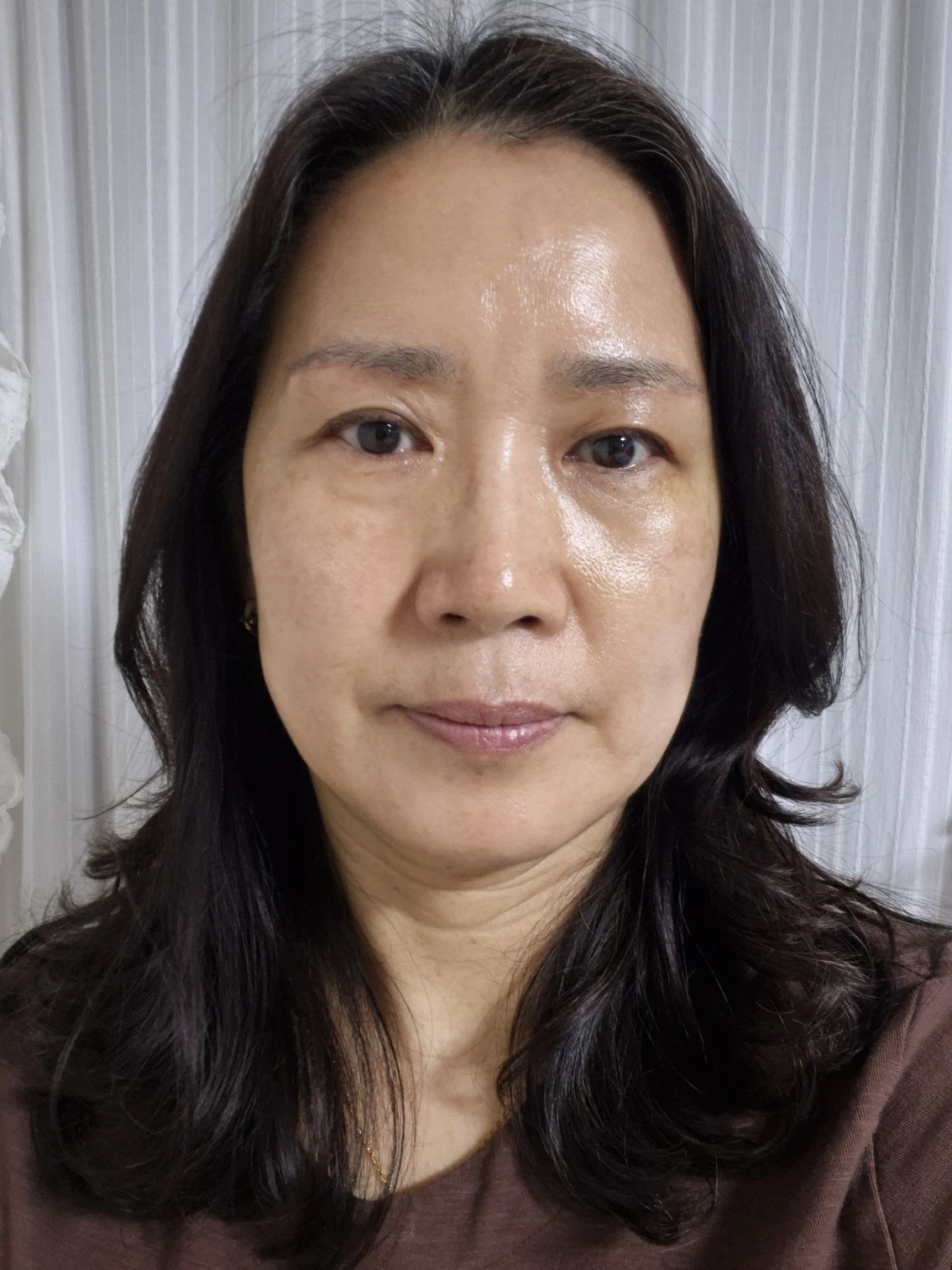 Sub-brow lift: recovery photographs through six months · Case 086 at Answer Plastic Surgery. Front view — 3 weeks after surgery, sub-brow lift at Answer Plastic Surgery (case 086).