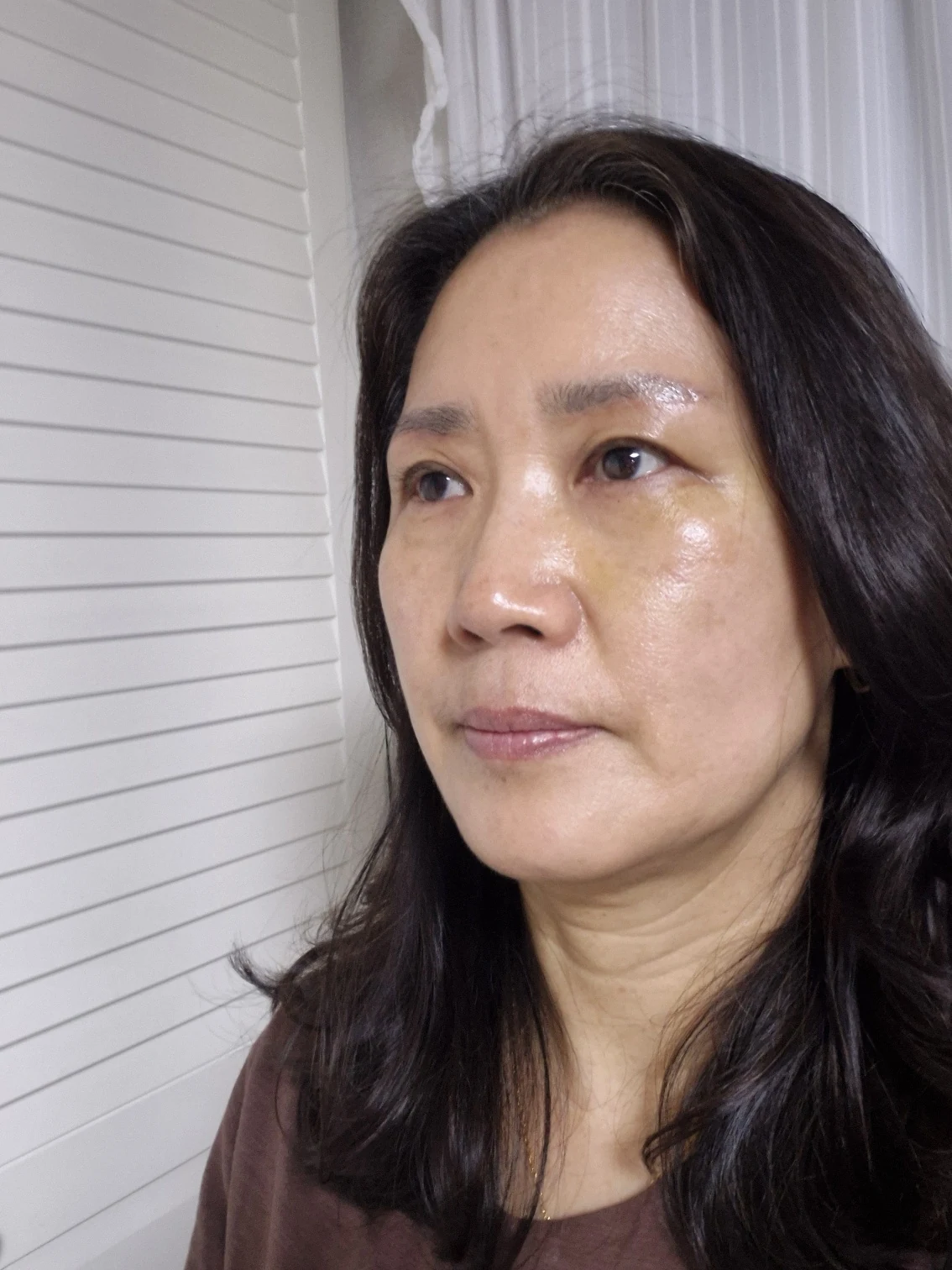Sub-brow lift: recovery photographs through six months · Case 086 at Answer Plastic Surgery. Oblique view — 3 weeks after surgery, sub-brow lift at Answer Plastic Surgery (case 086).