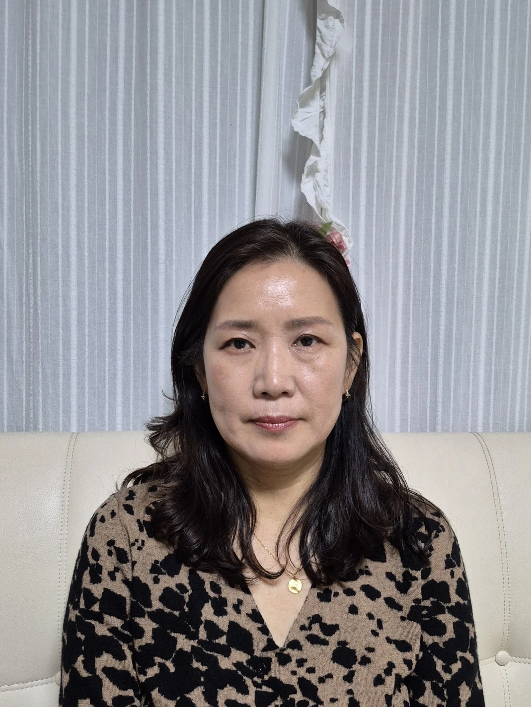 Sub-brow lift: recovery photographs through six months · Case 086 at Answer Plastic Surgery. Front view — 1 month after surgery, sub-brow lift at Answer Plastic Surgery (case 086).